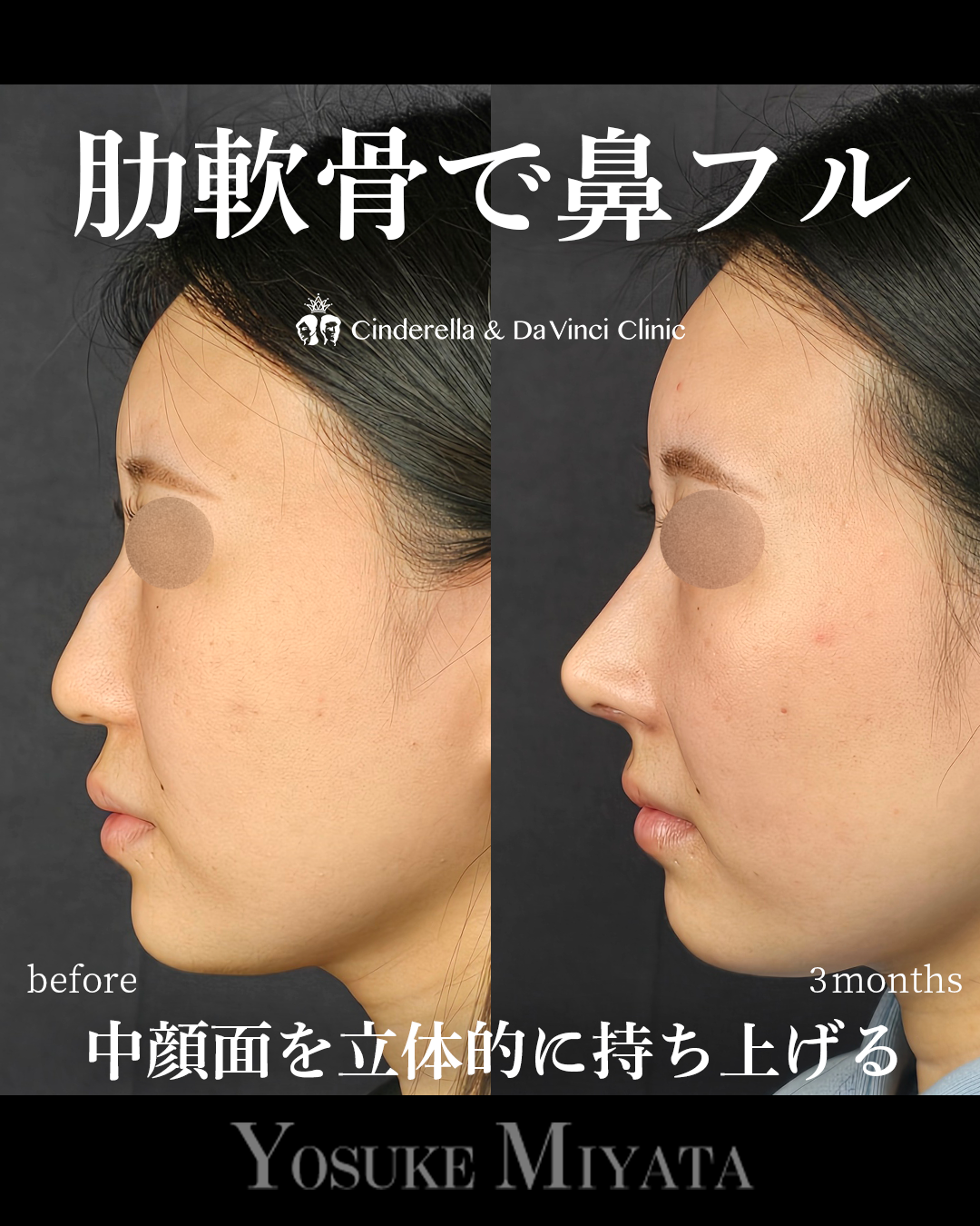 肋軟骨を使った鼻フルの画像