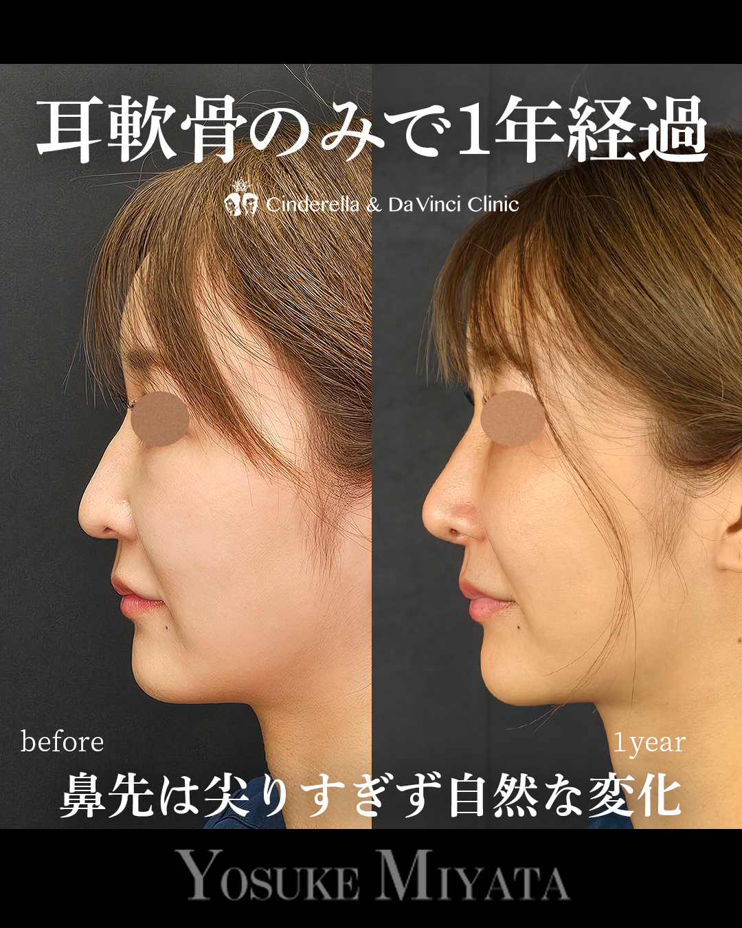 耳介軟骨の鼻整形で1年の画像