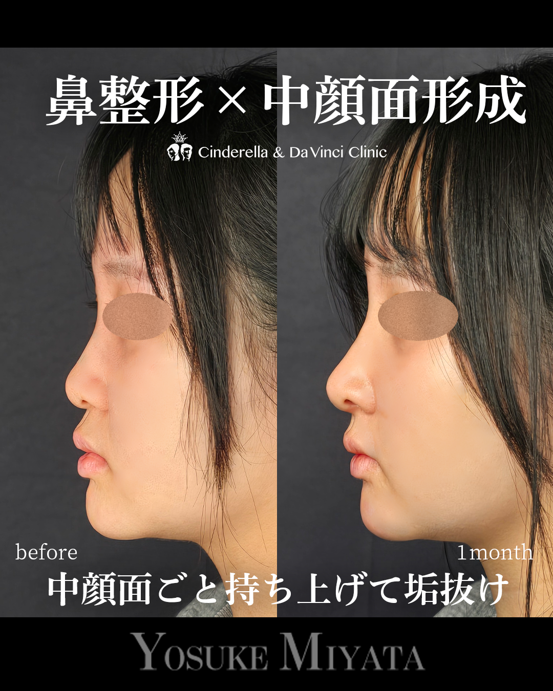 中顔面形成の画像