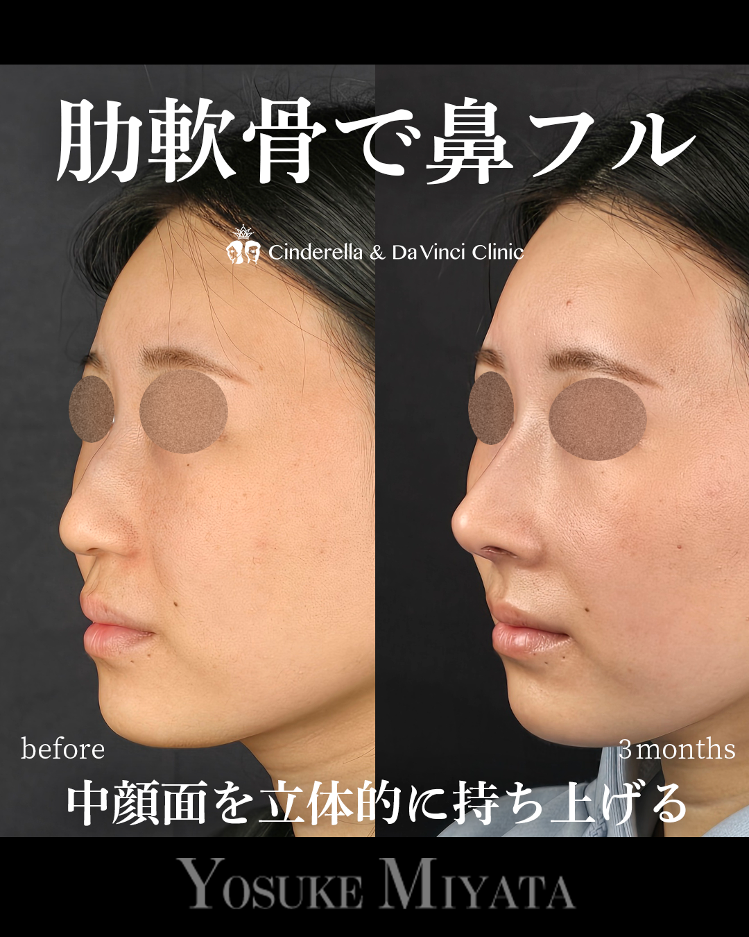 肋軟骨を使った鼻フルの画像