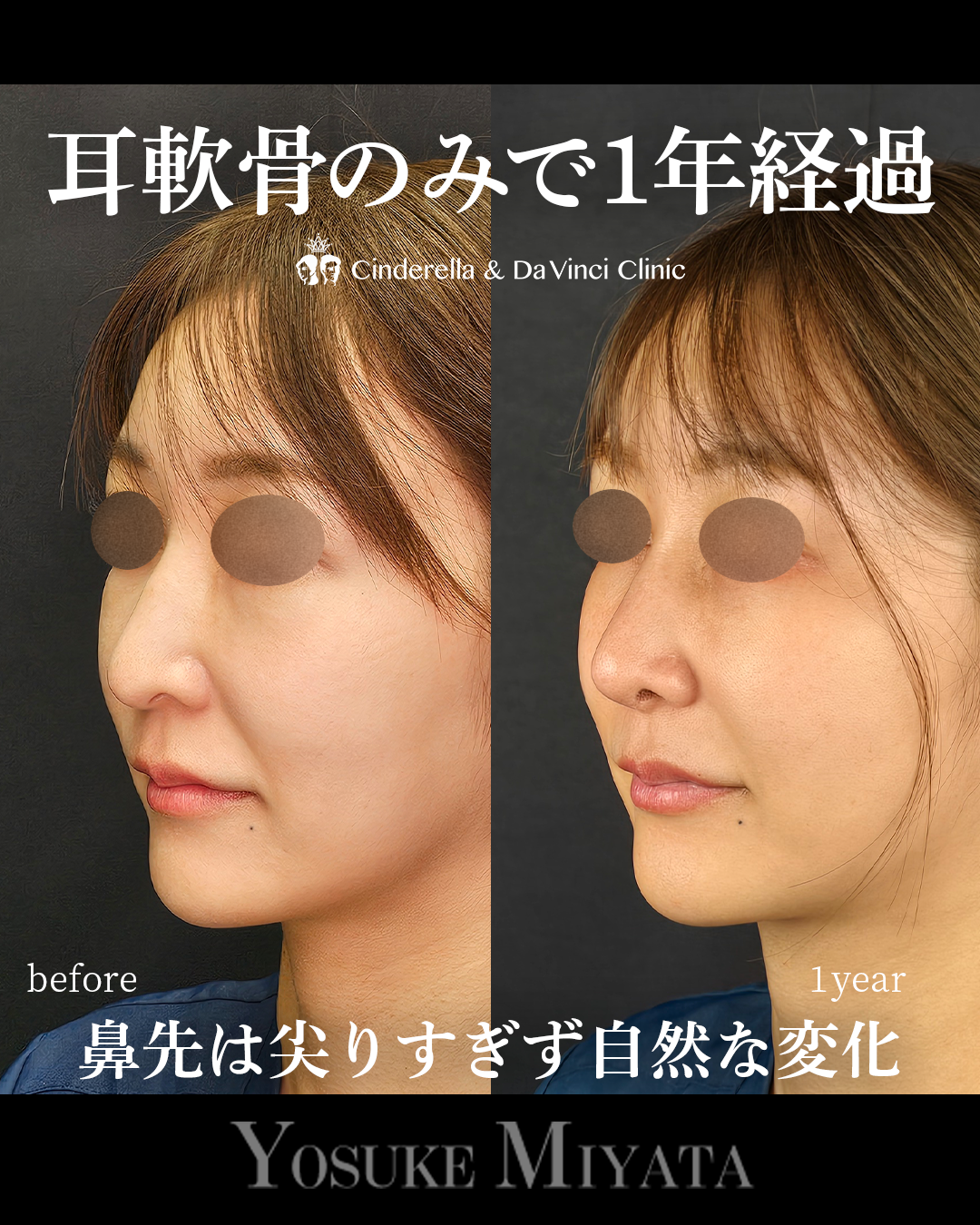 耳介軟骨の鼻整形で1年の画像