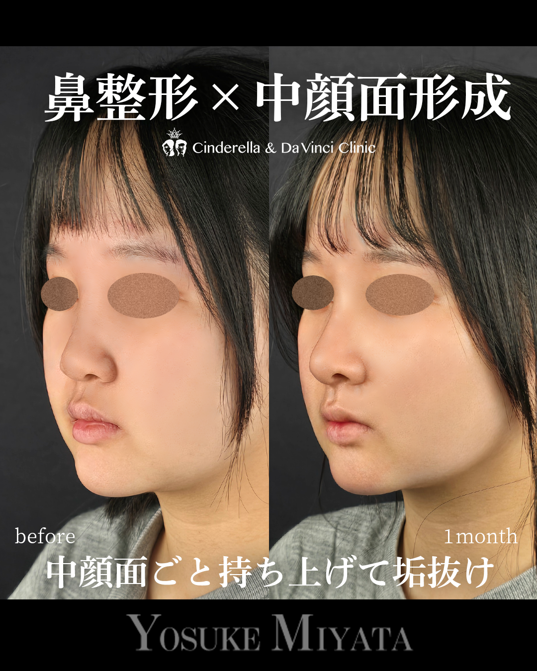 中顔面形成の画像