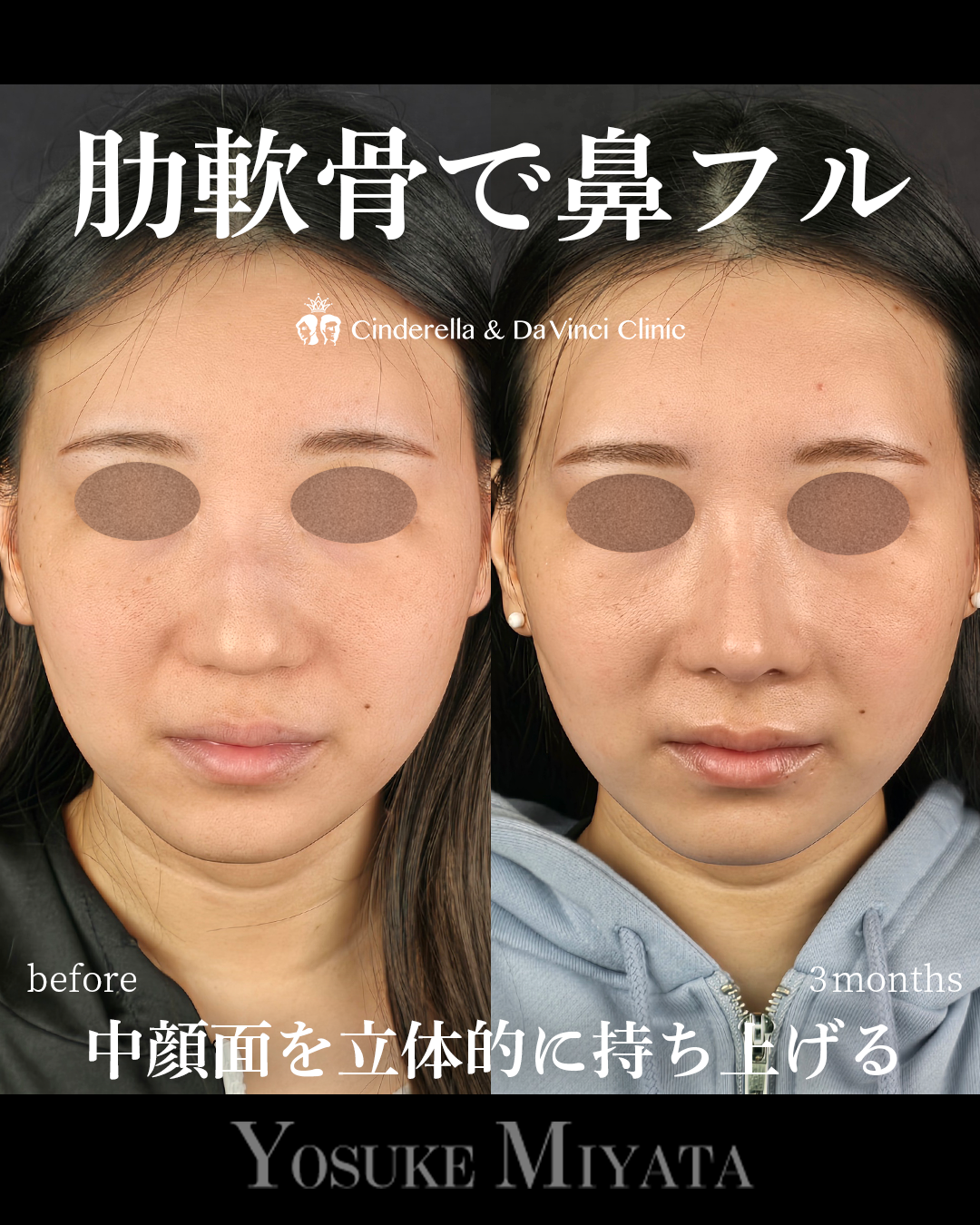 肋軟骨を使った鼻フルの画像