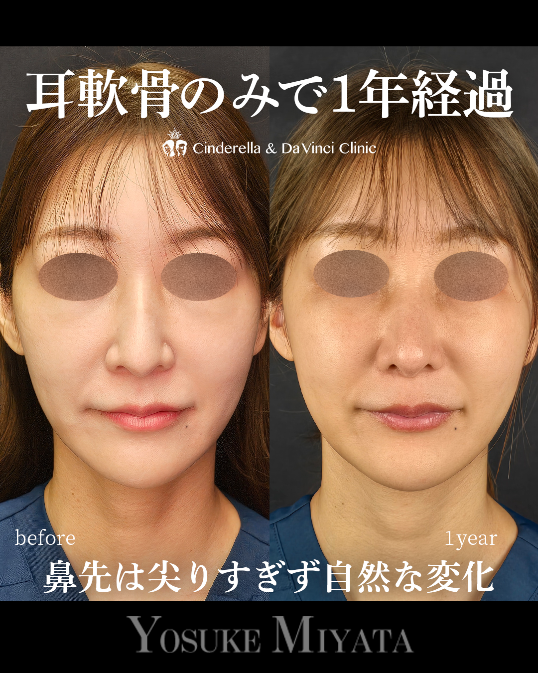 耳介軟骨の鼻整形で1年の画像