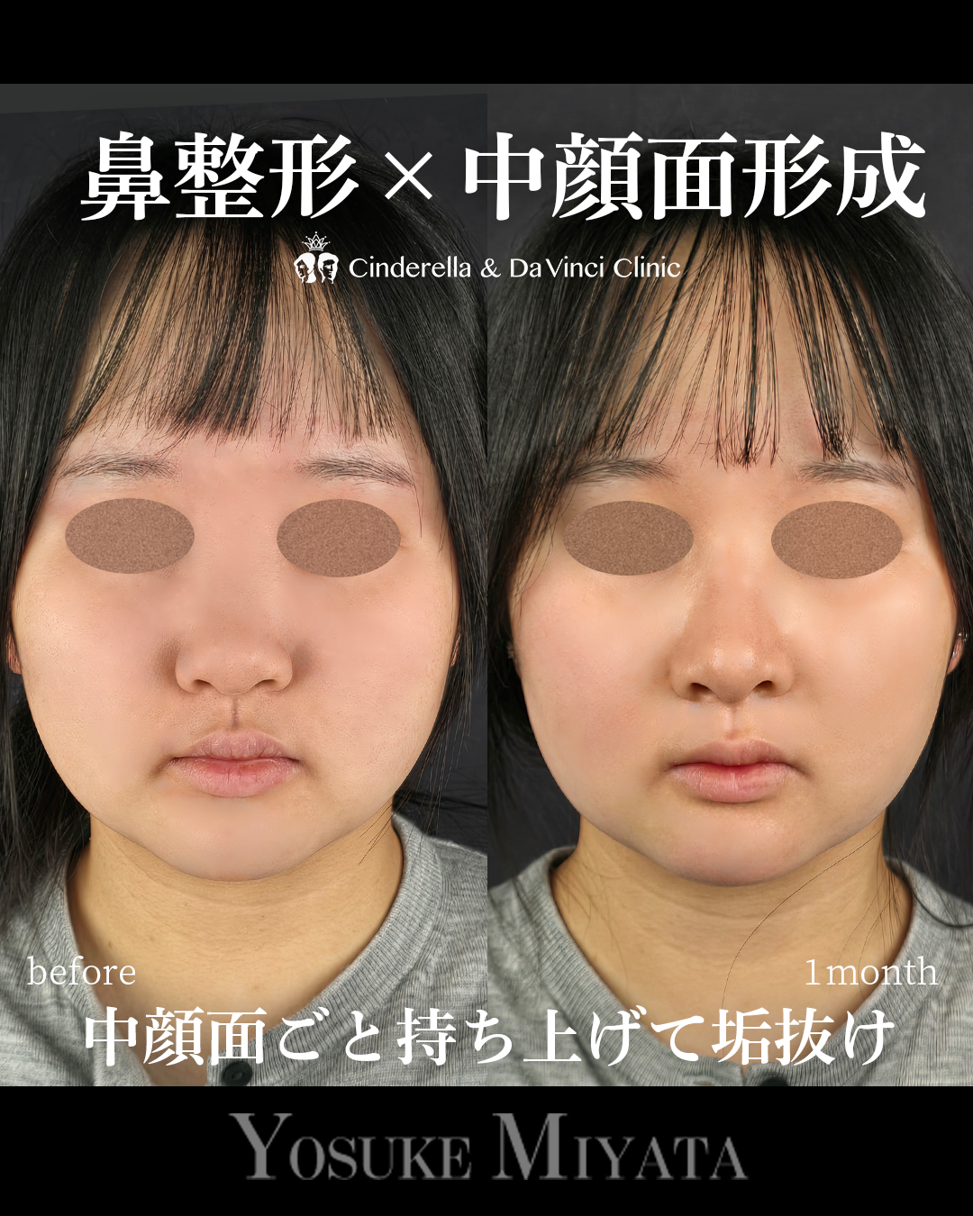 中顔面形成の画像