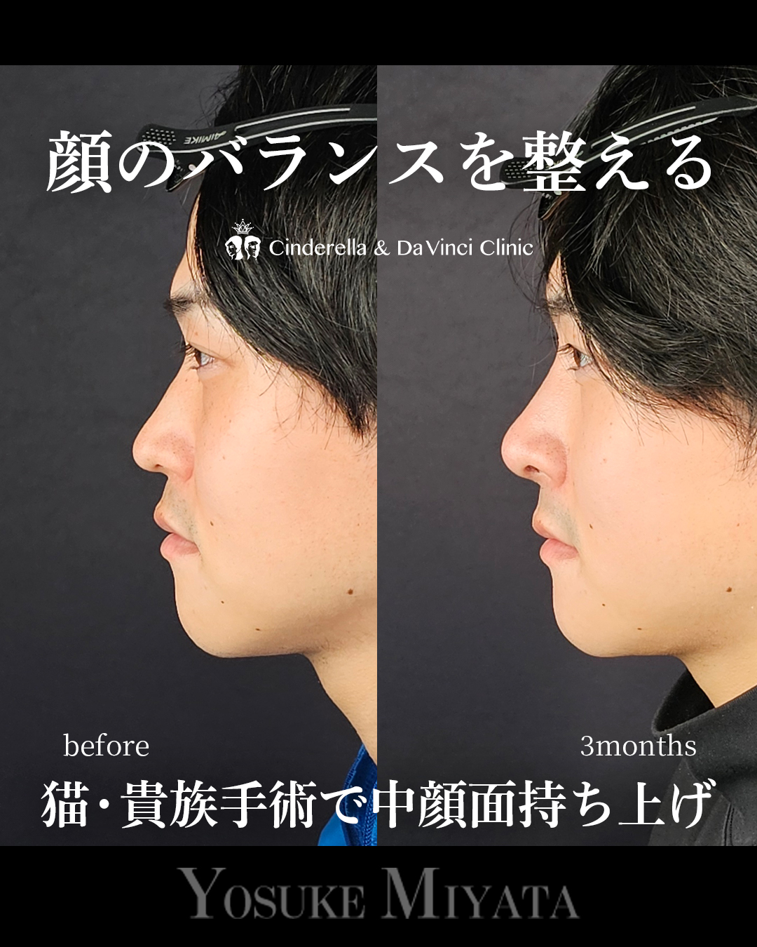 鼻整形で顔のバランスを整えるの画像