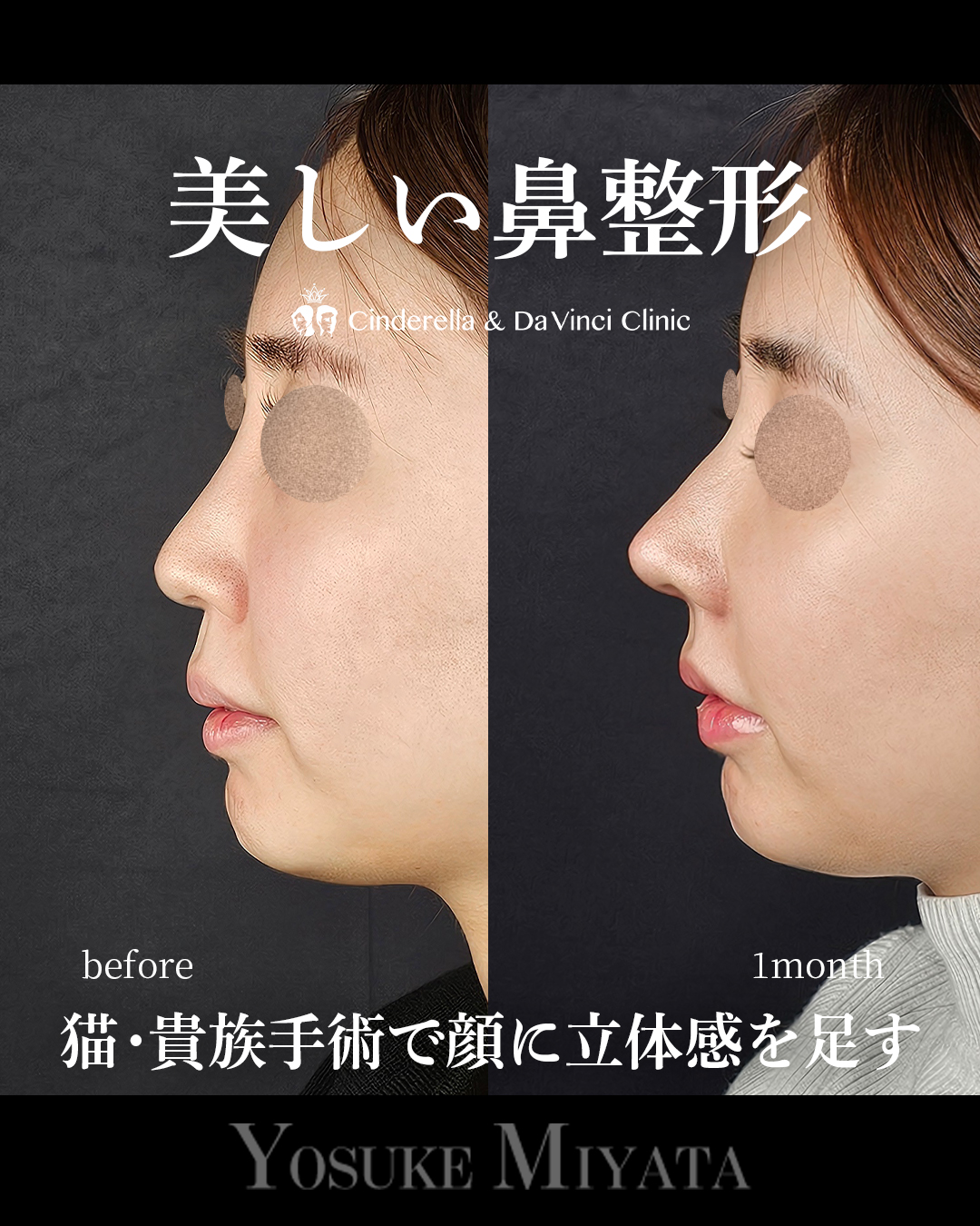 美しい鼻整形の画像