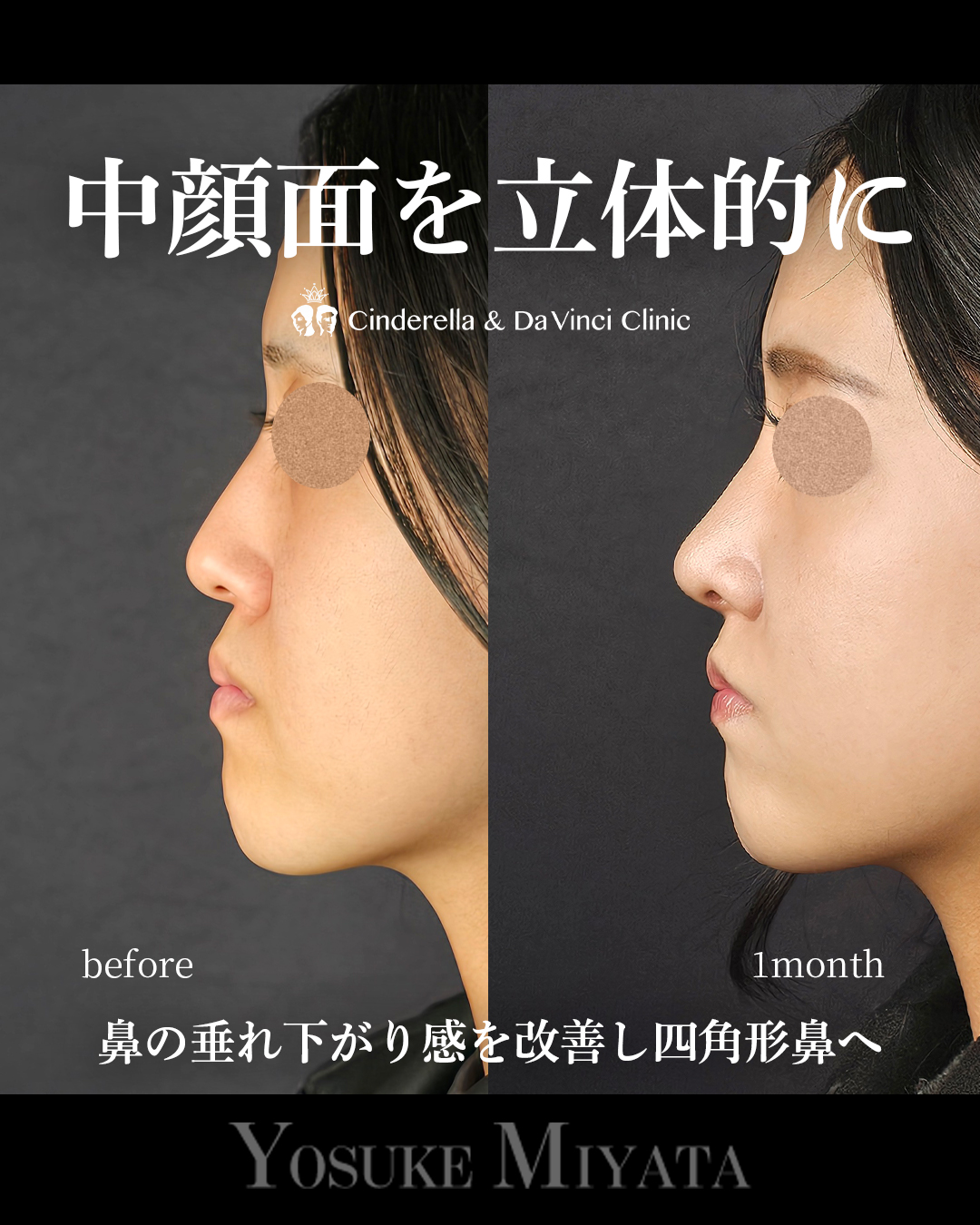 中顔面を立体的にの画像