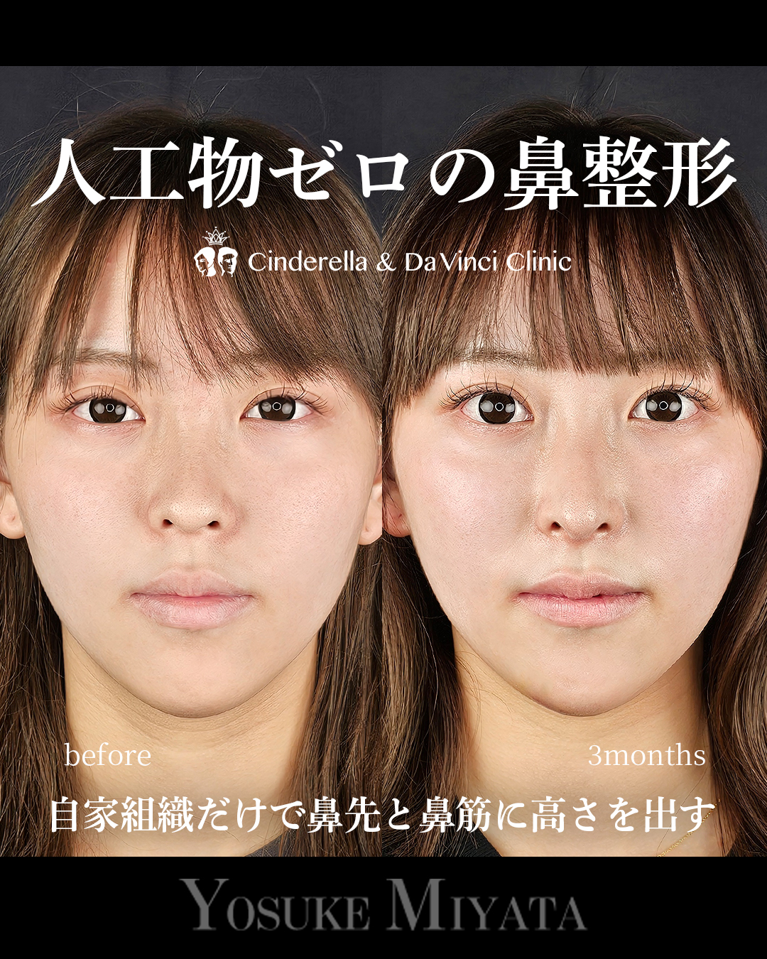 人工物なしの鼻整形の画像