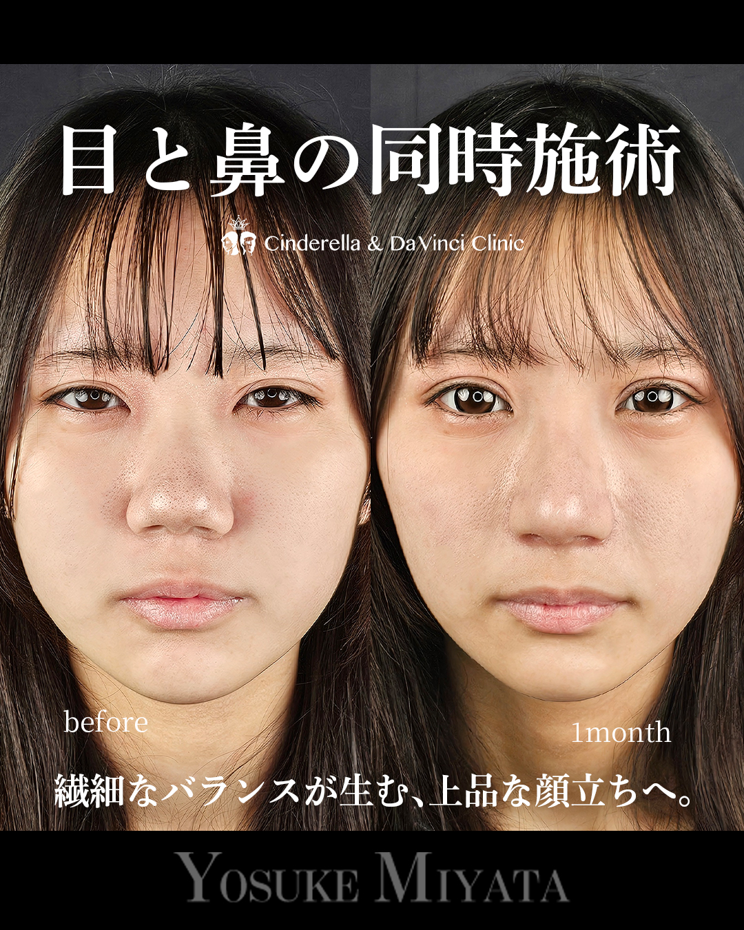 目と鼻の同時施術の画像