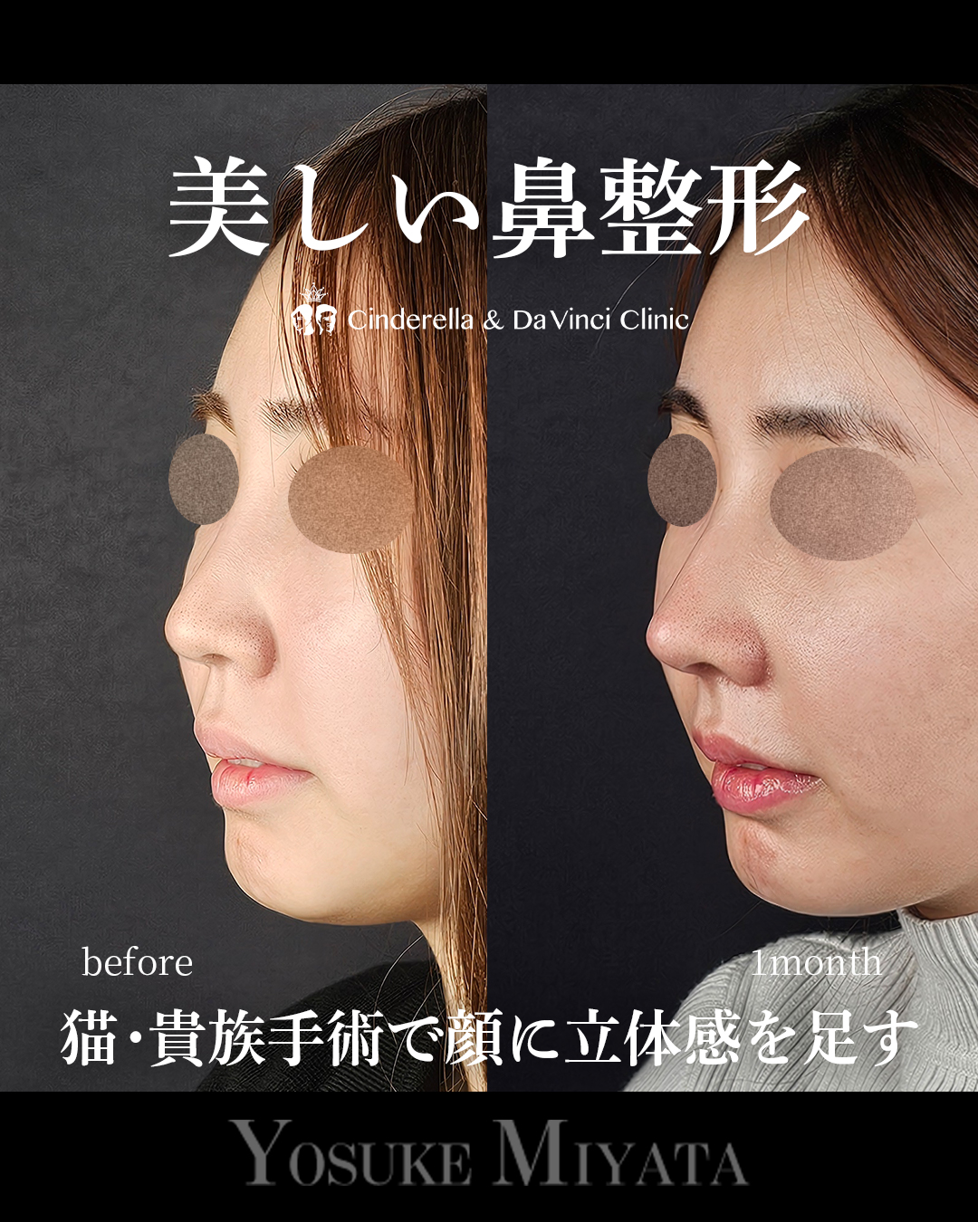 美しい鼻整形の画像