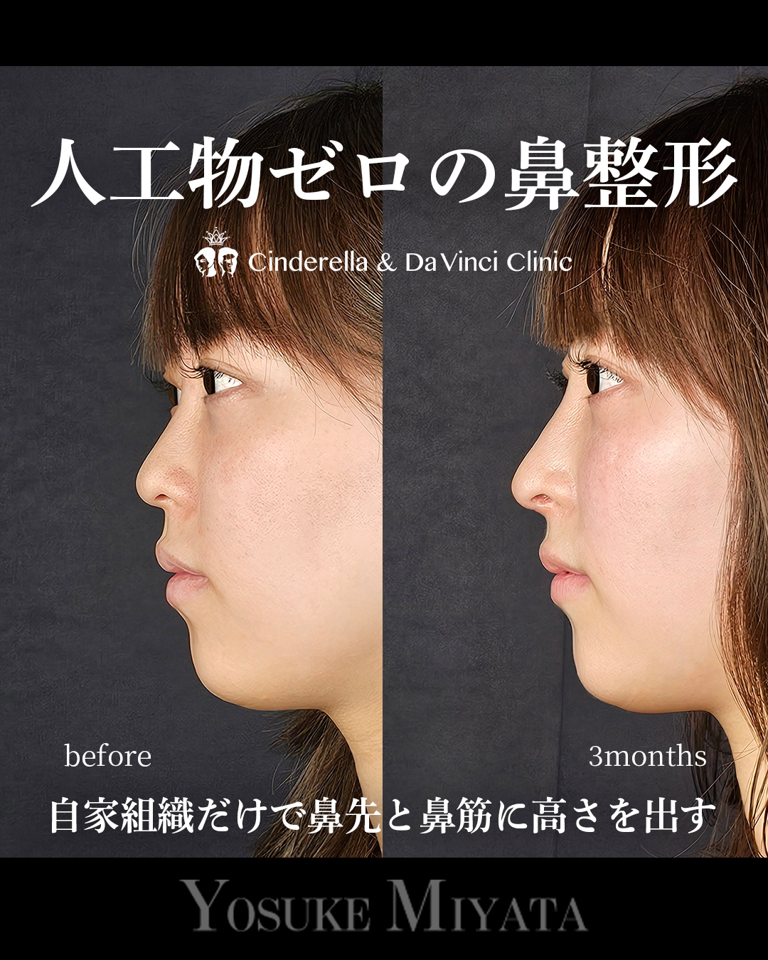 人工物なしの鼻整形の画像