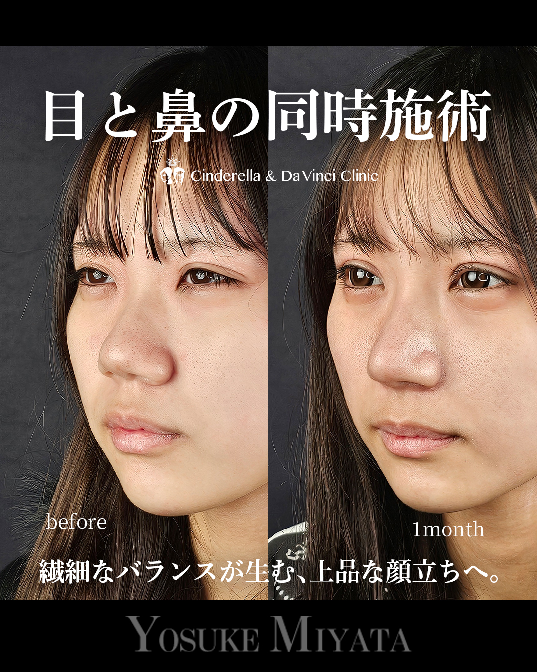 目と鼻の同時施術の画像