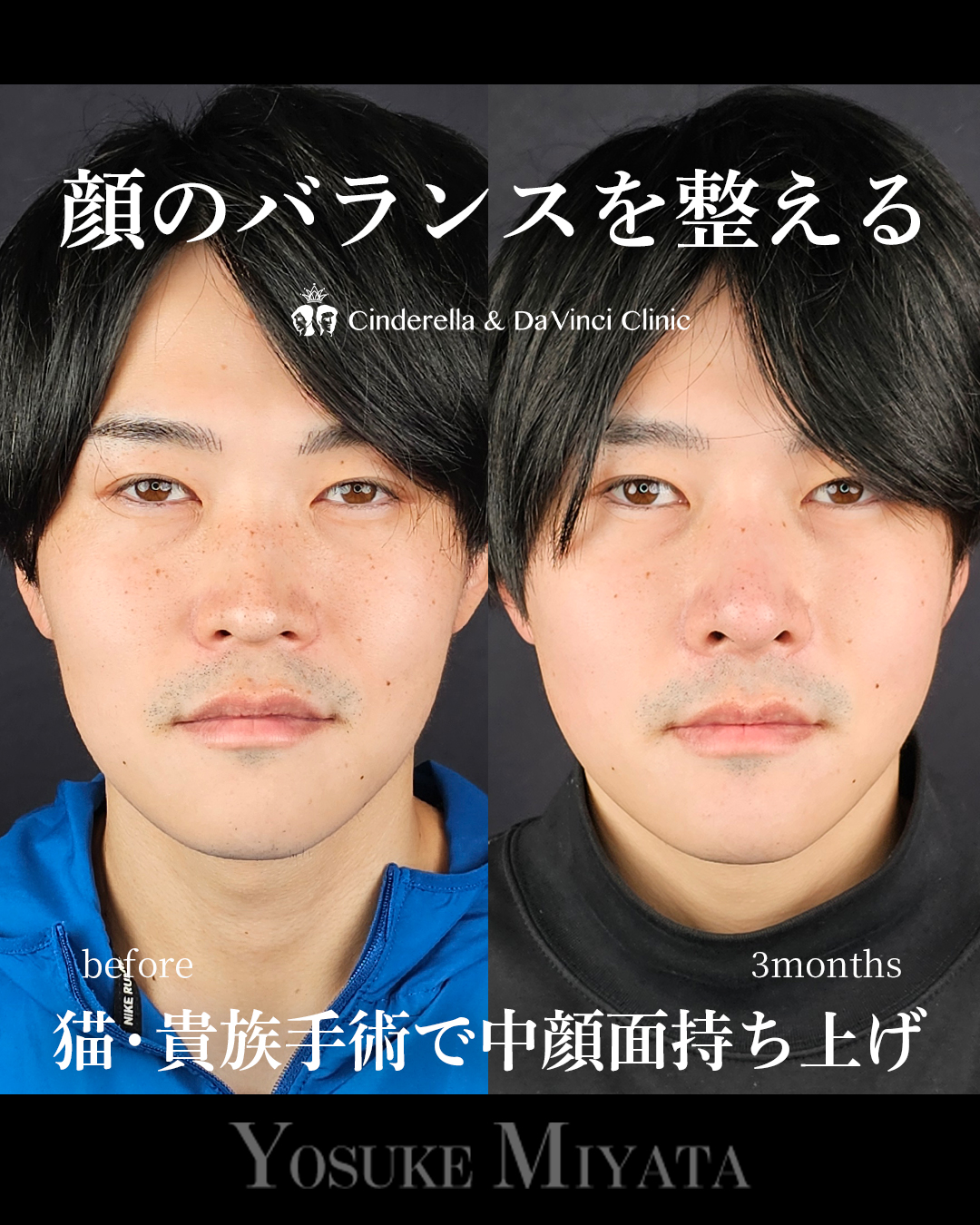 鼻整形で顔のバランスを整えるの画像