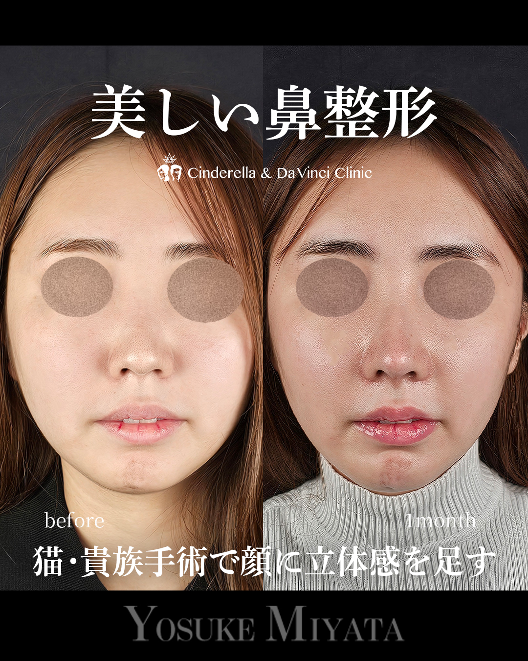 美しい鼻整形の画像