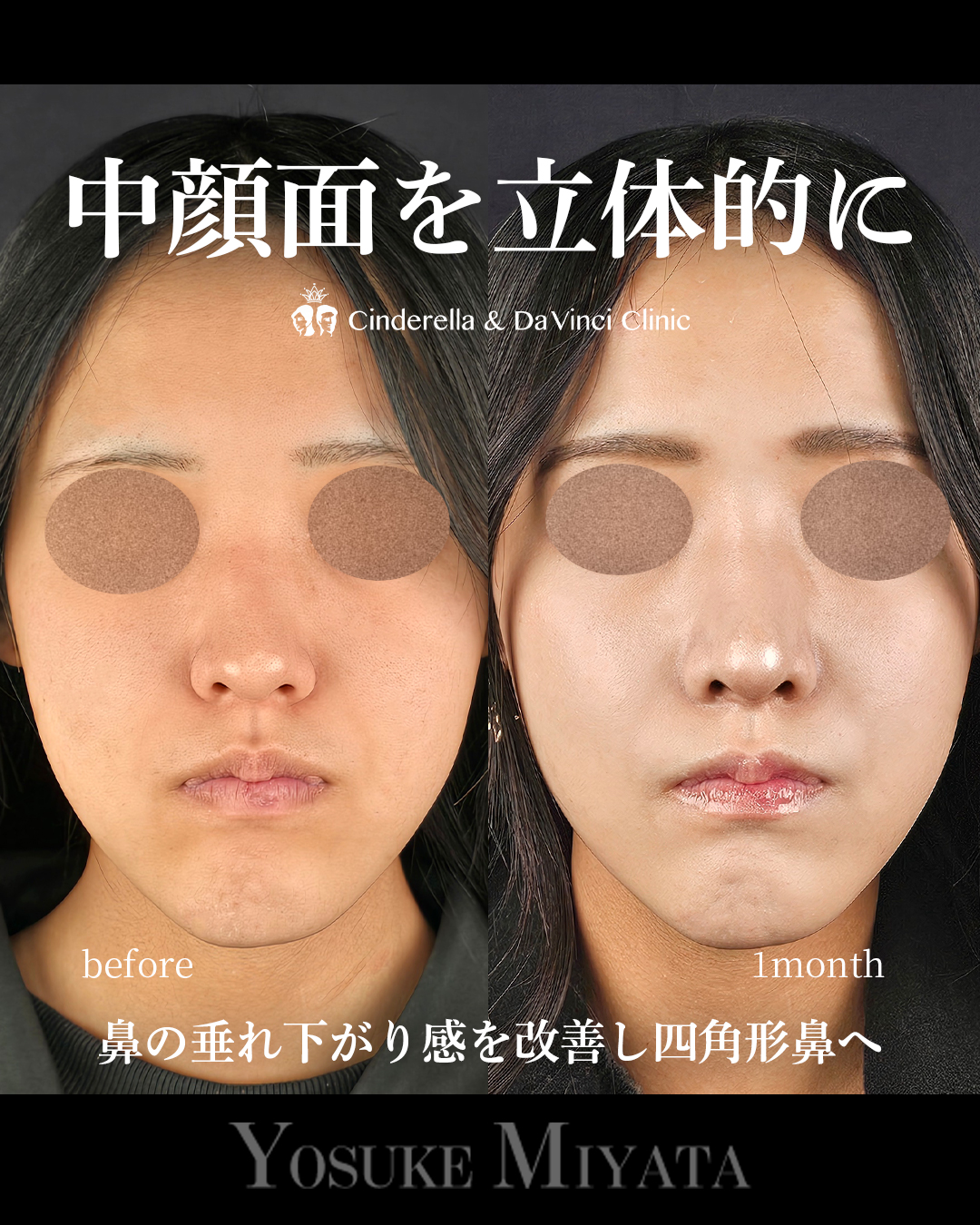 中顔面を立体的にの画像