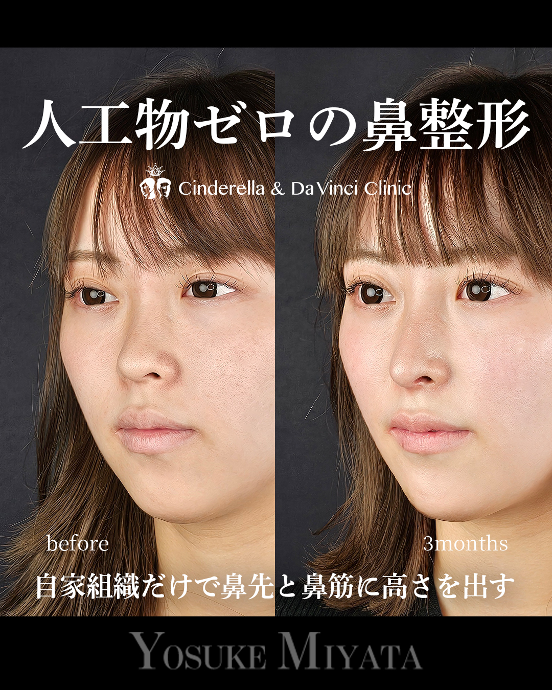 人工物なしの鼻整形の画像