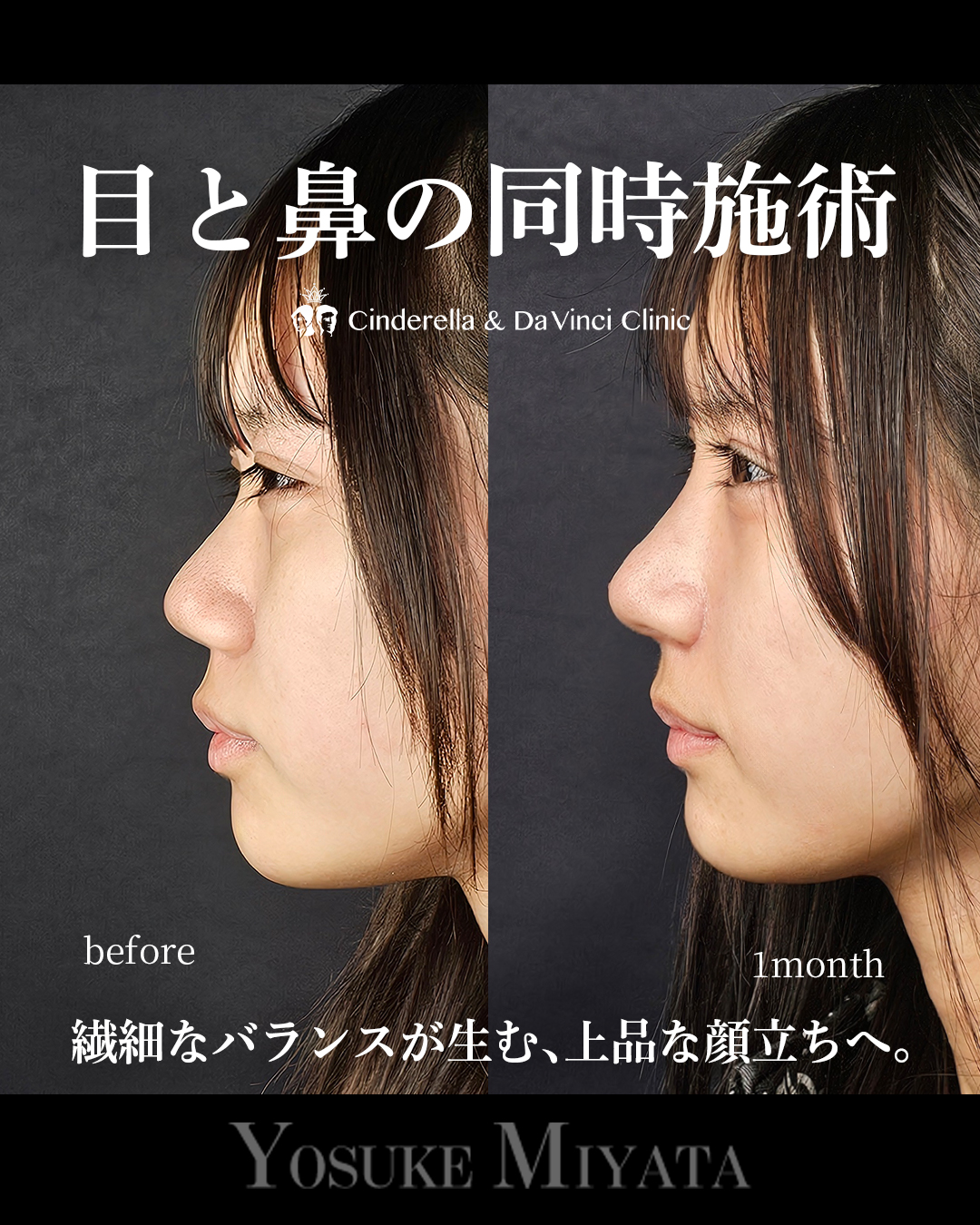 目と鼻の同時施術の画像