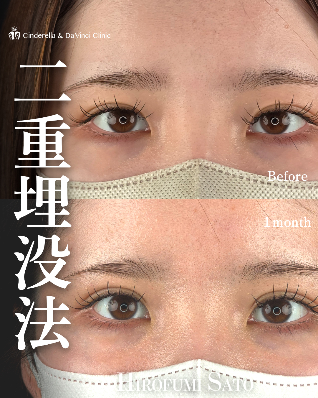 二重幅を少しだけ広げるの画像