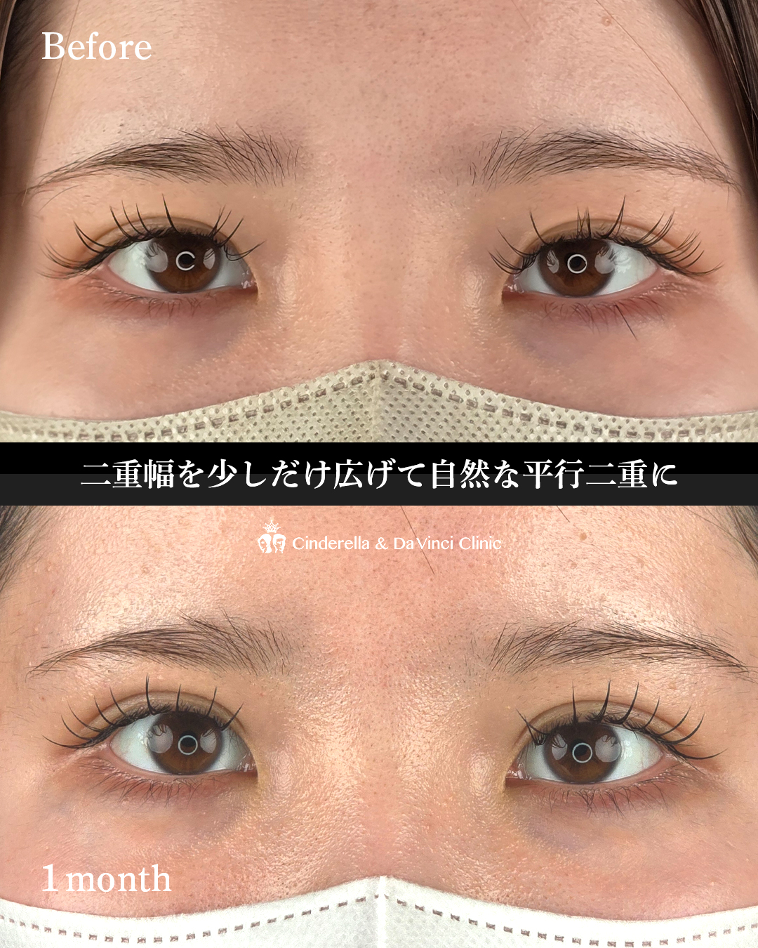 二重幅を少しだけ広げるの画像