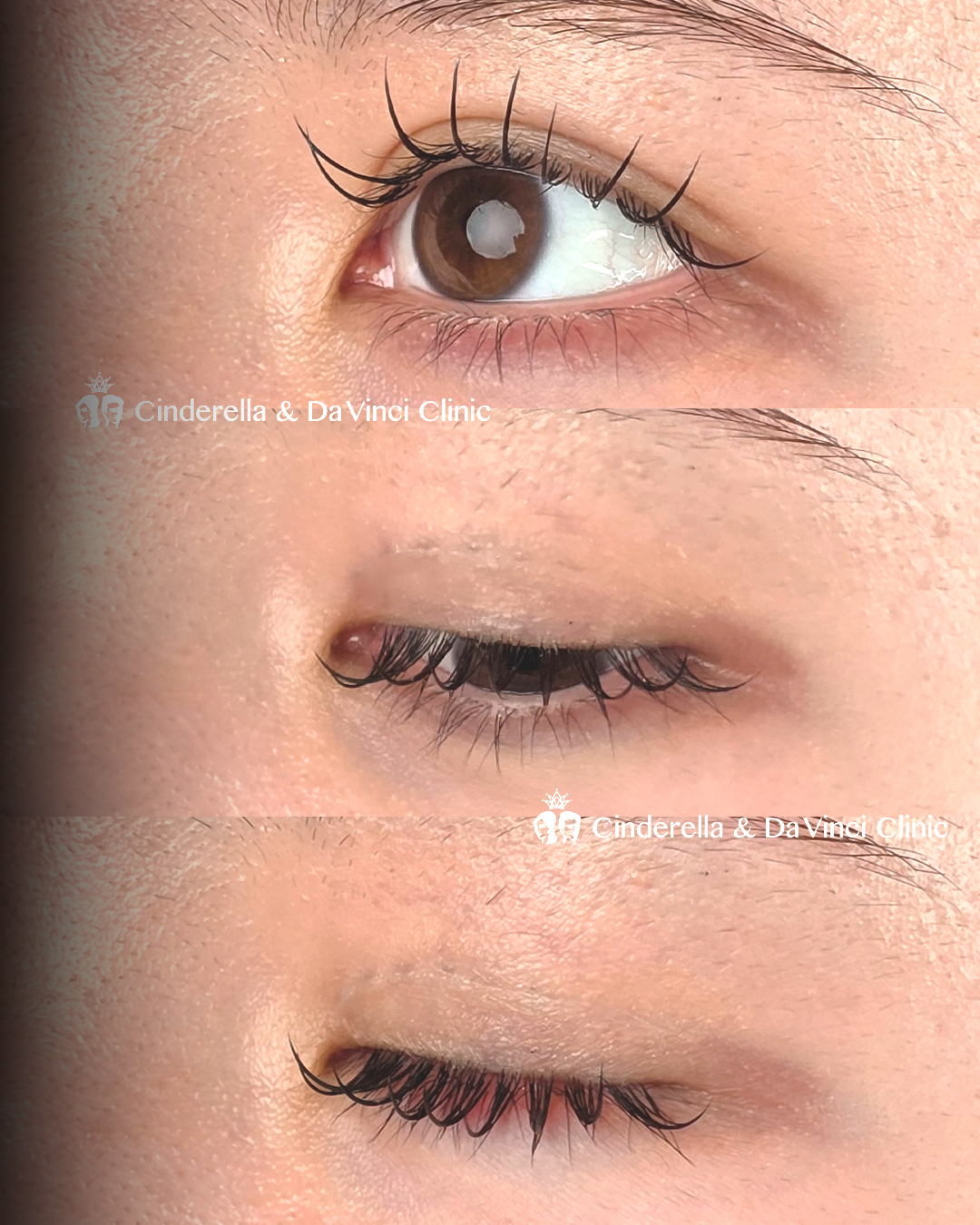 二重幅を少しだけ広げるの画像