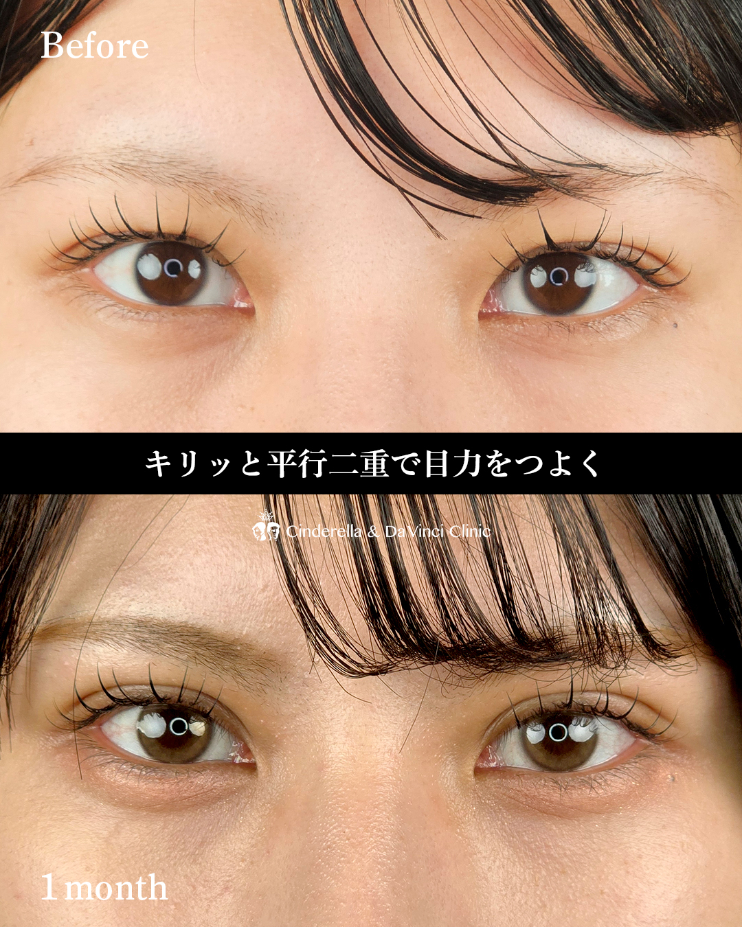 自然癒着法の平行二重の画像