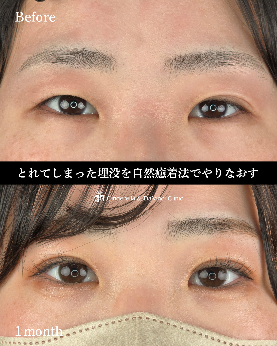 自然癒着で埋没やりなおしの画像