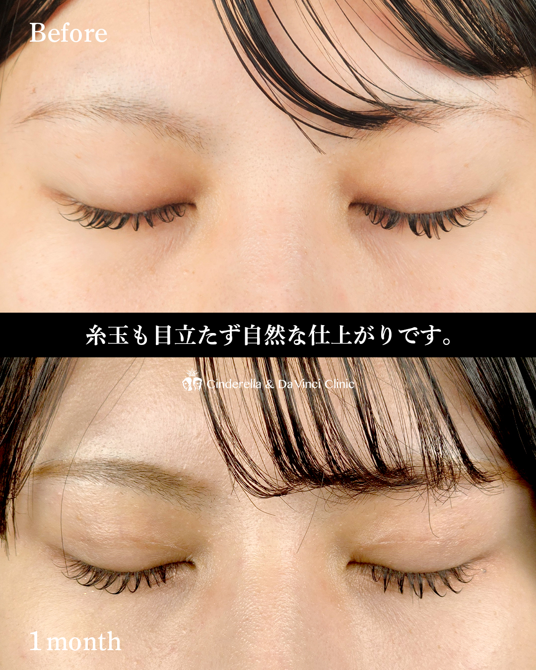 自然癒着法の平行二重の画像