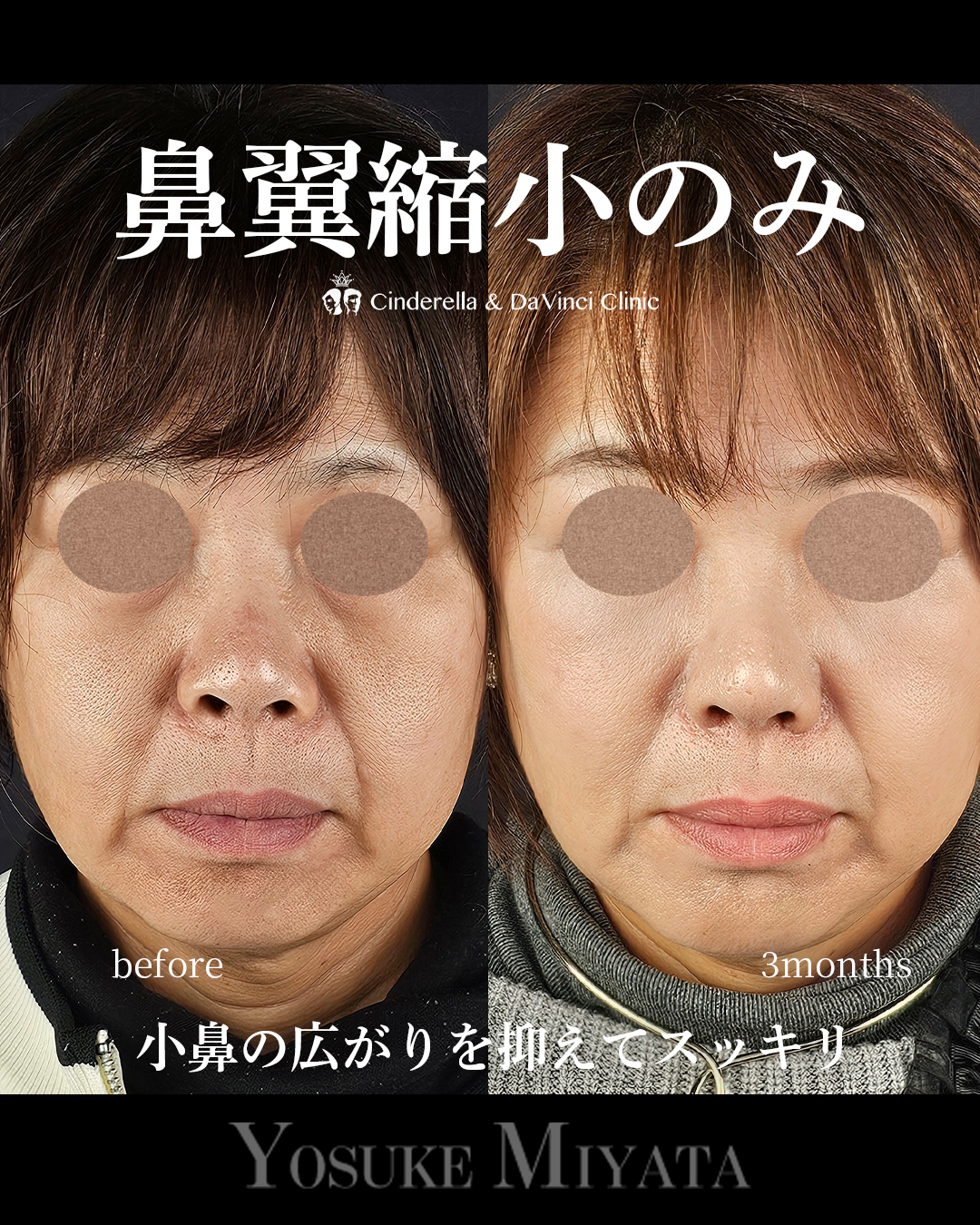 鼻翼縮小のみの画像