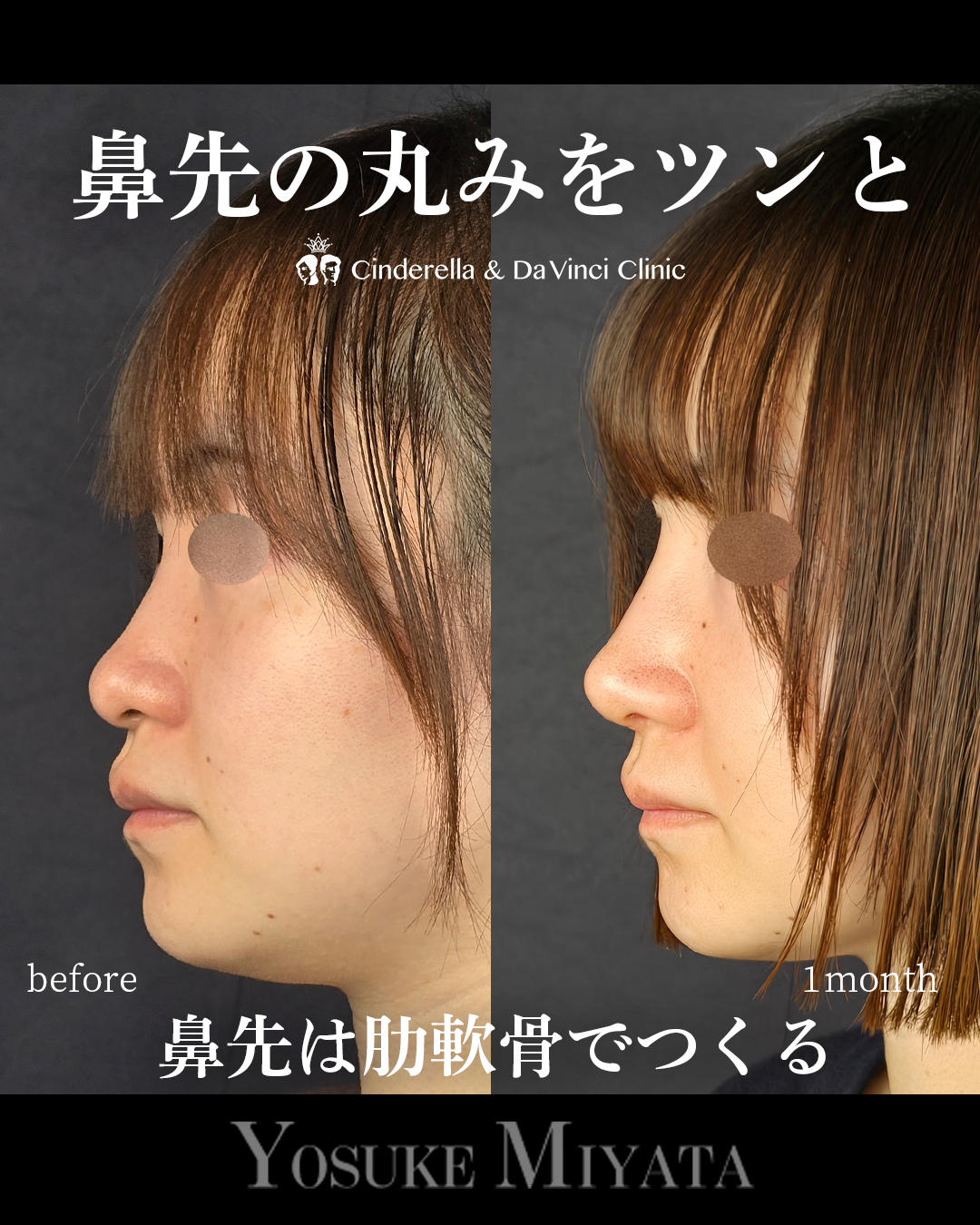鼻先の丸みをツンと | 名古屋の美容外科・美容皮膚科ならCinderella & Da Vinci Clinic【公式】