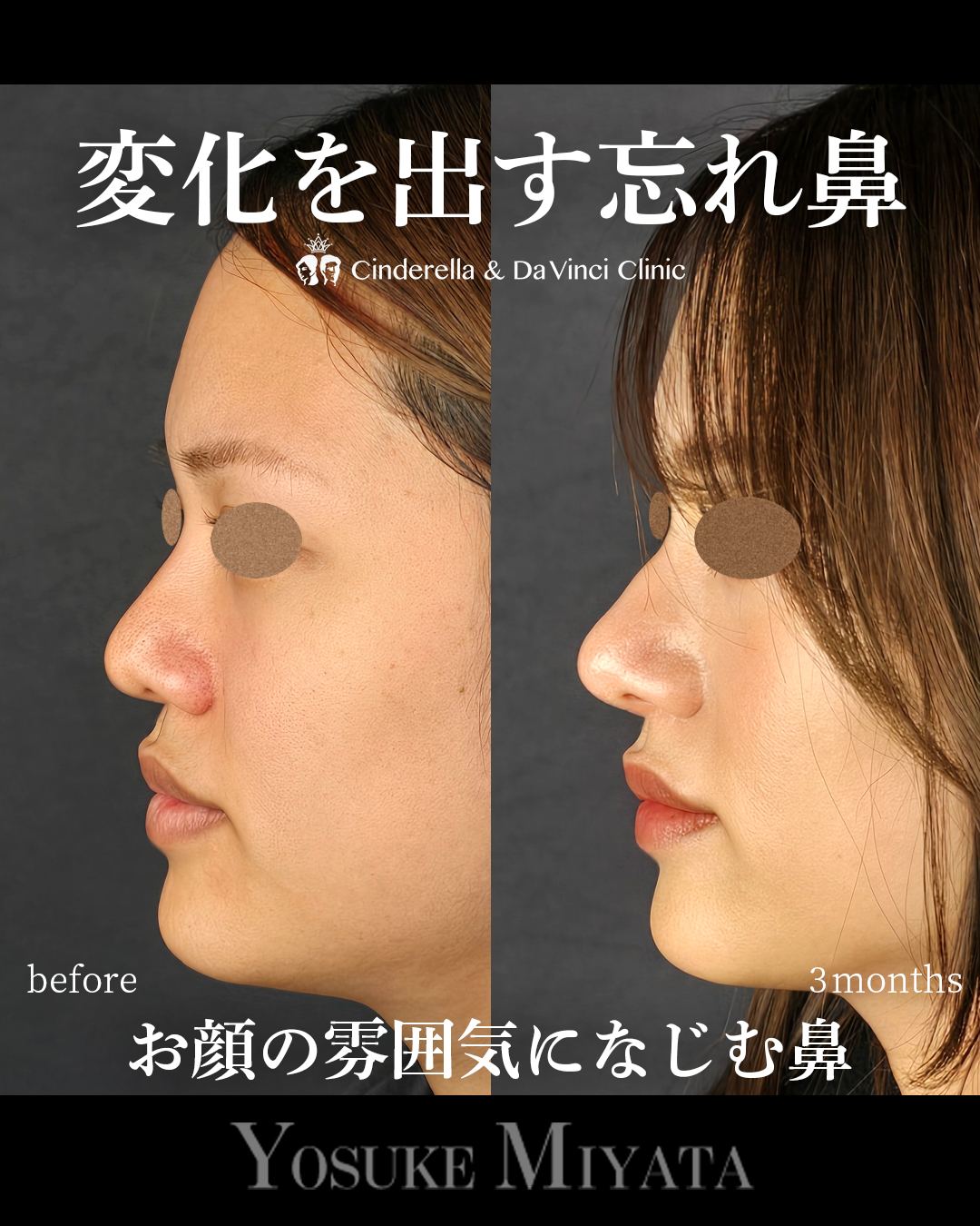 ナチュラルな忘れ鼻の画像