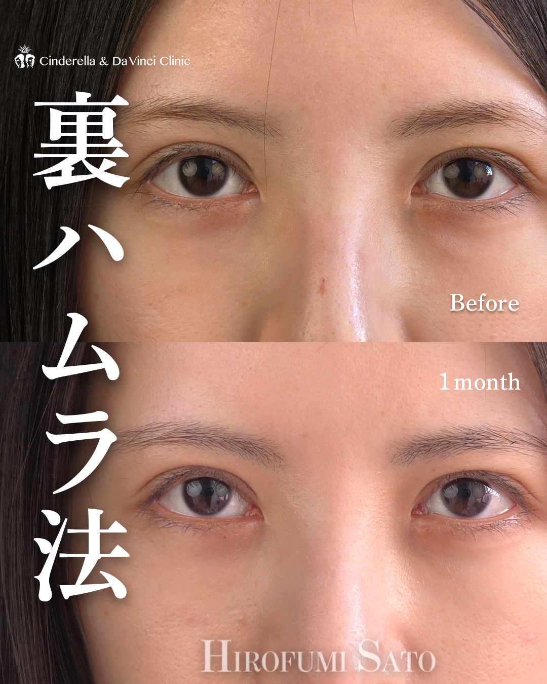 目の下の影改善