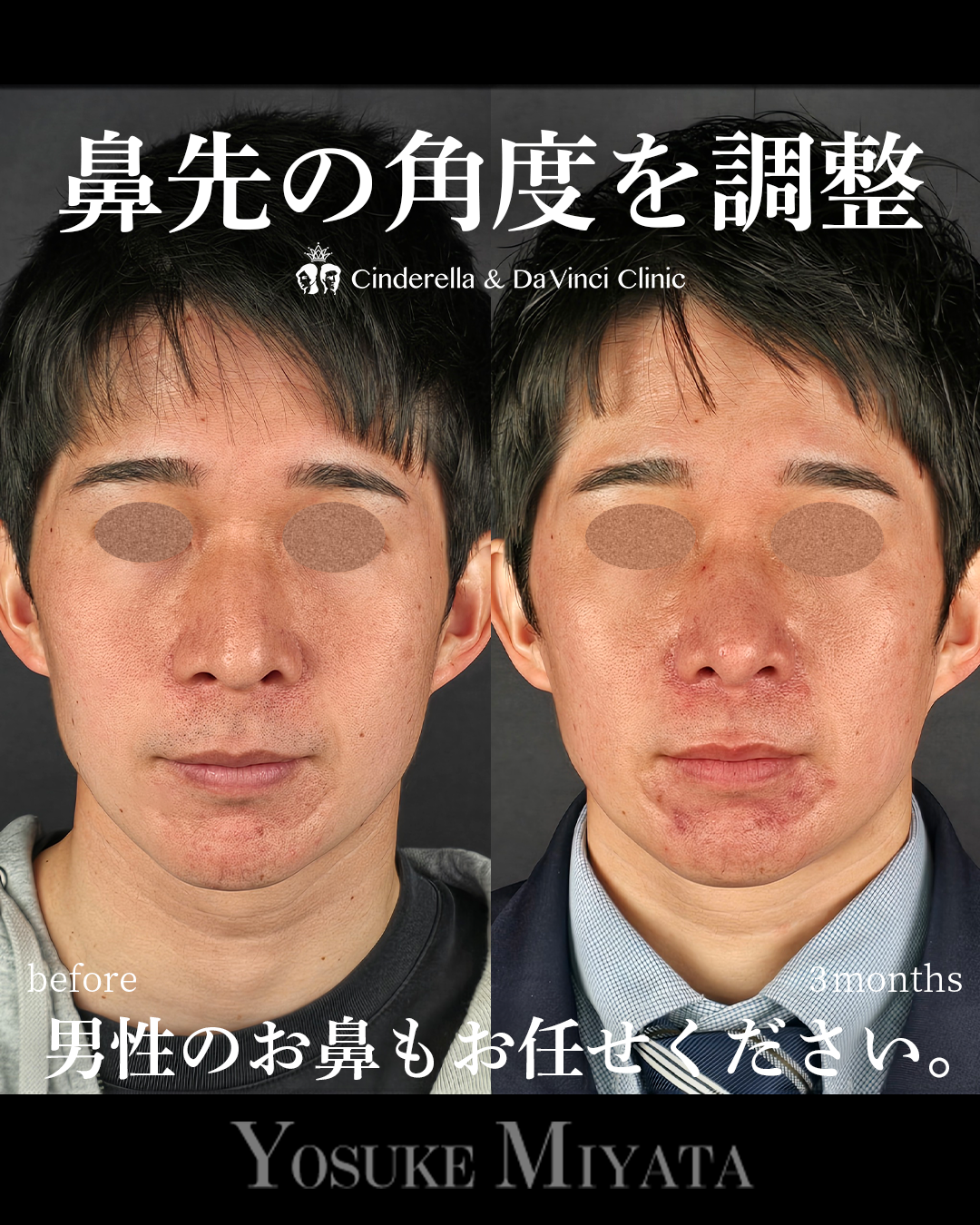 鼻先をツンとさせるの画像