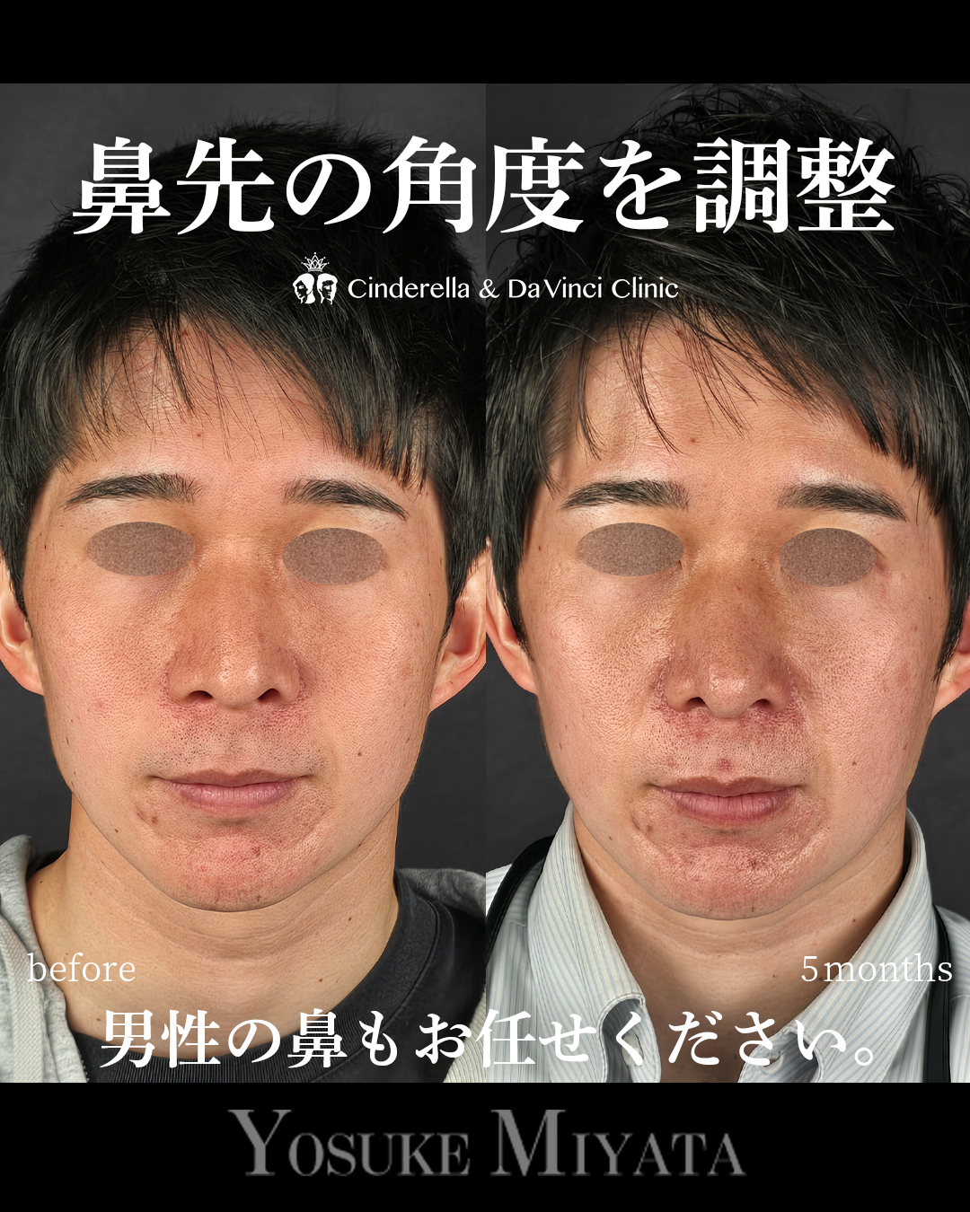 鼻先をツンとさせるの画像