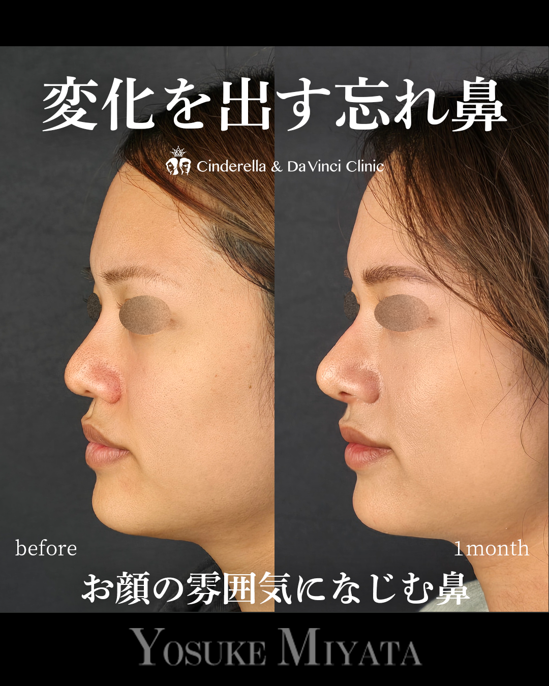 ナチュラルな忘れ鼻