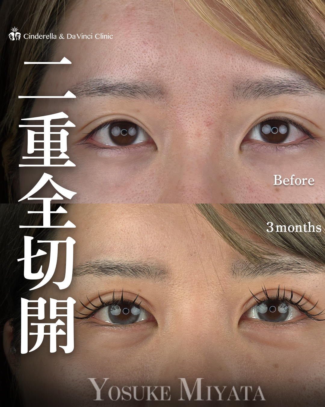 二重切開で平行二重