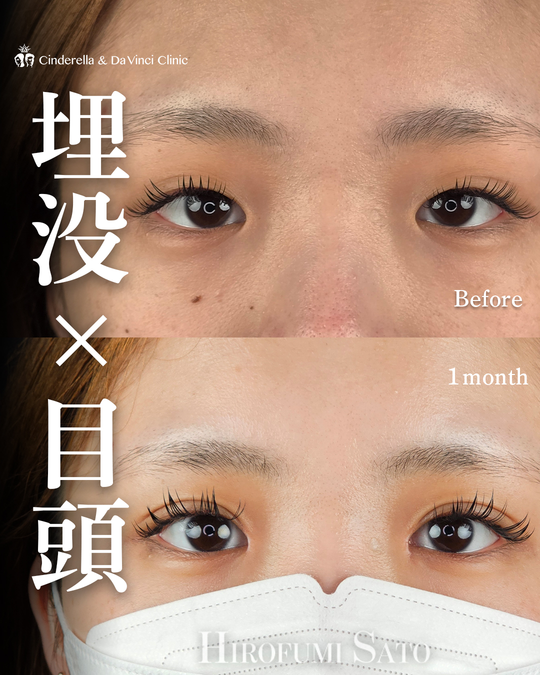 埋没と目頭同時手術