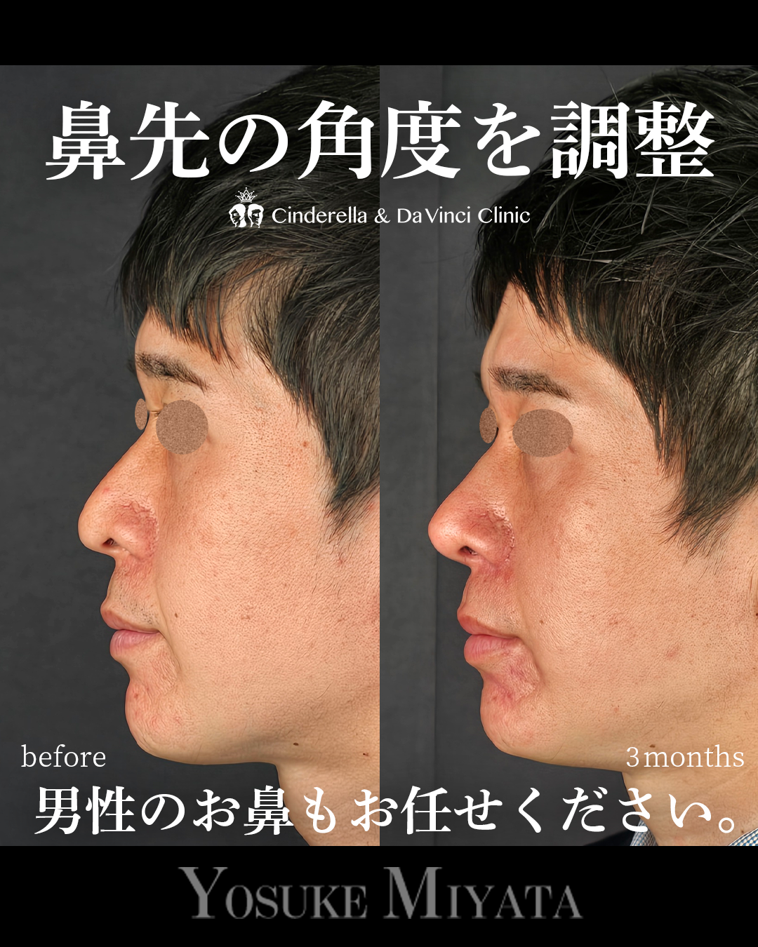 鼻先をツンとさせるの画像