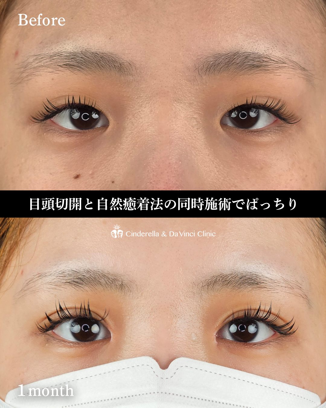 埋没と目頭同時手術の画像