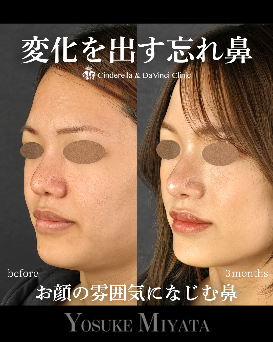 ナチュラルな忘れ鼻の画像