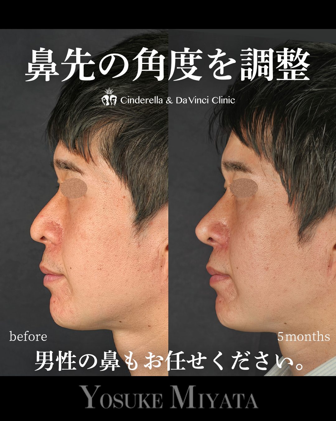 鼻先をツンとさせるの画像