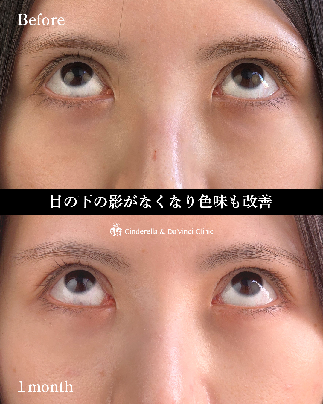 目の下の影改善の画像