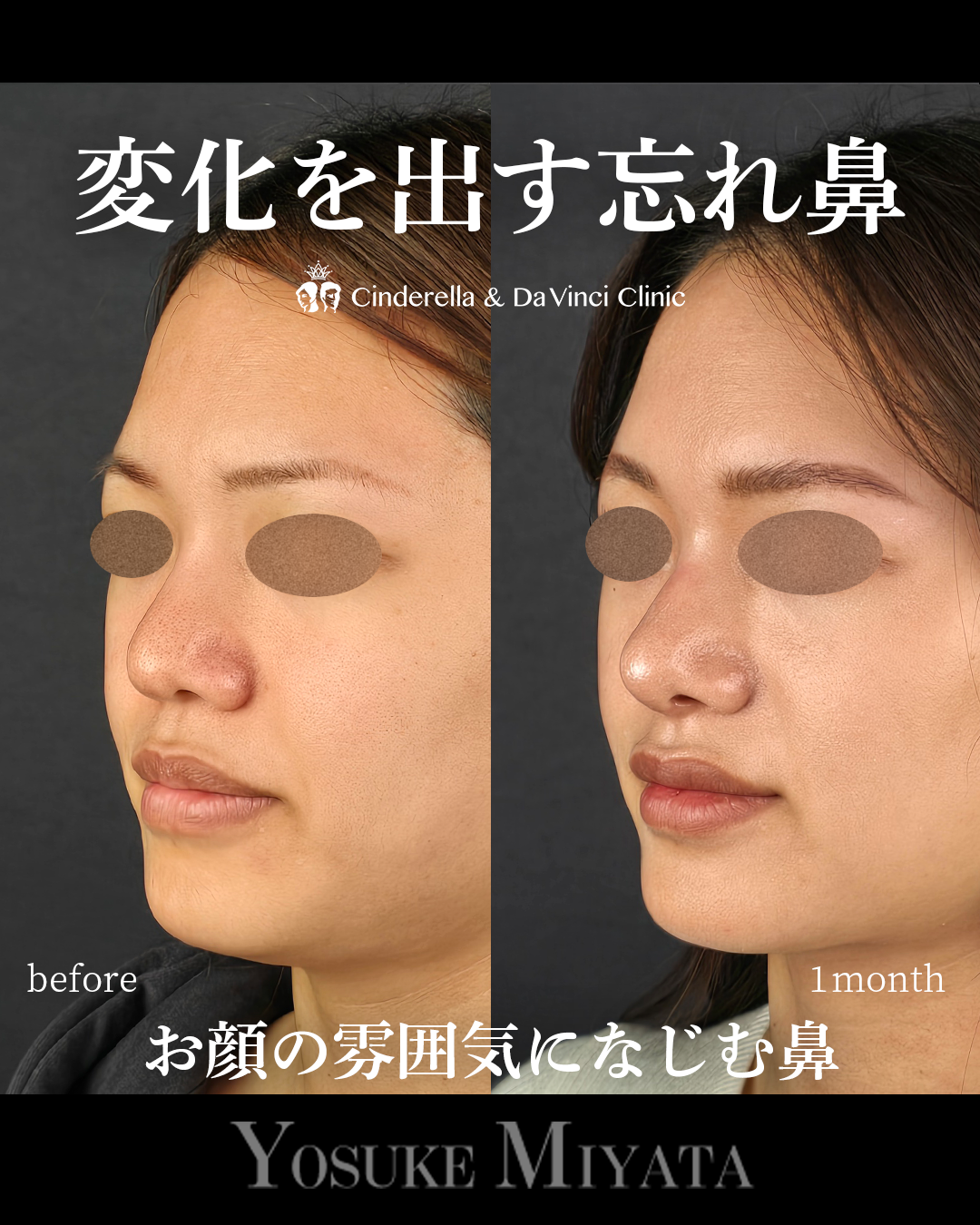 ナチュラルな忘れ鼻の画像