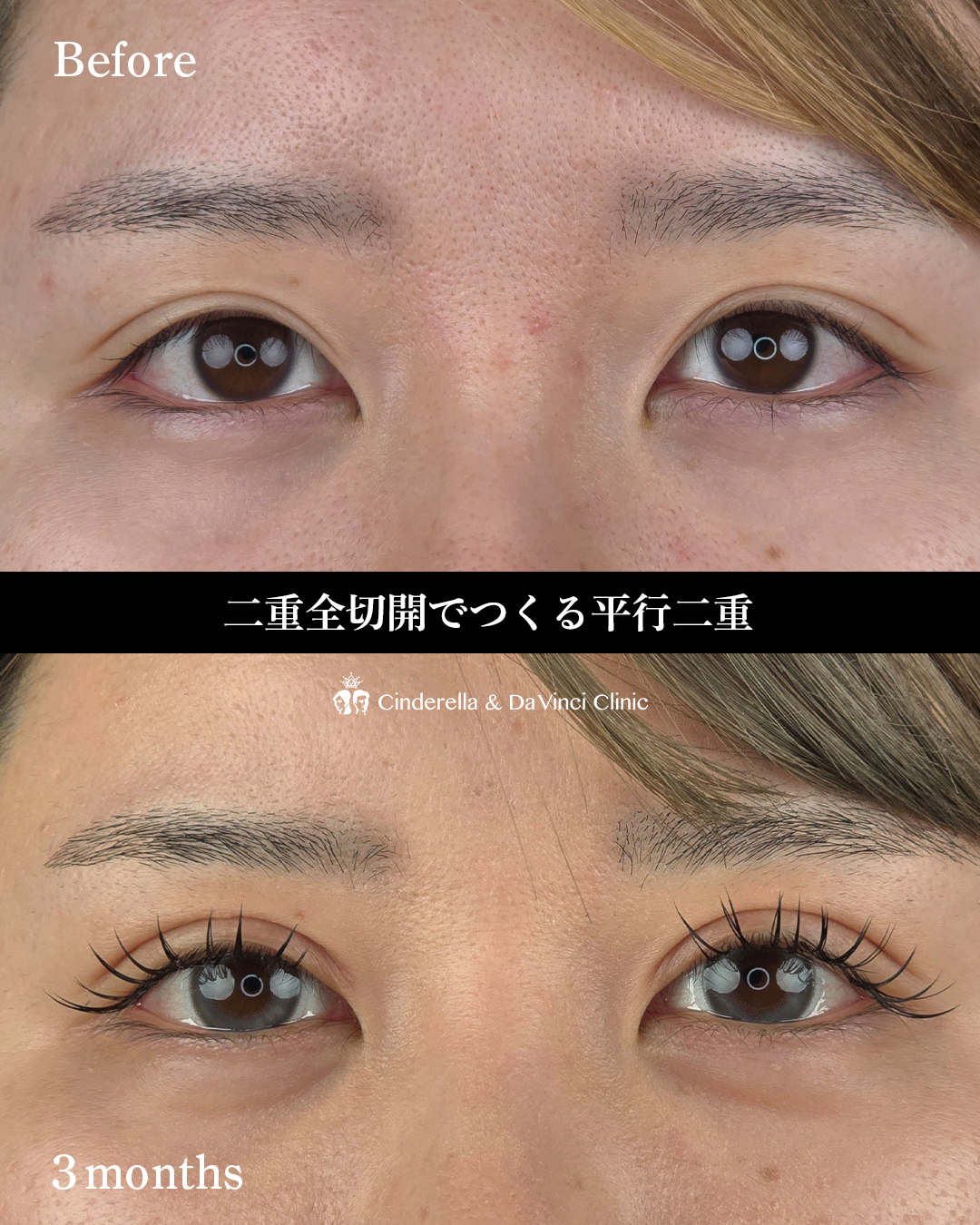 二重切開で平行二重の画像