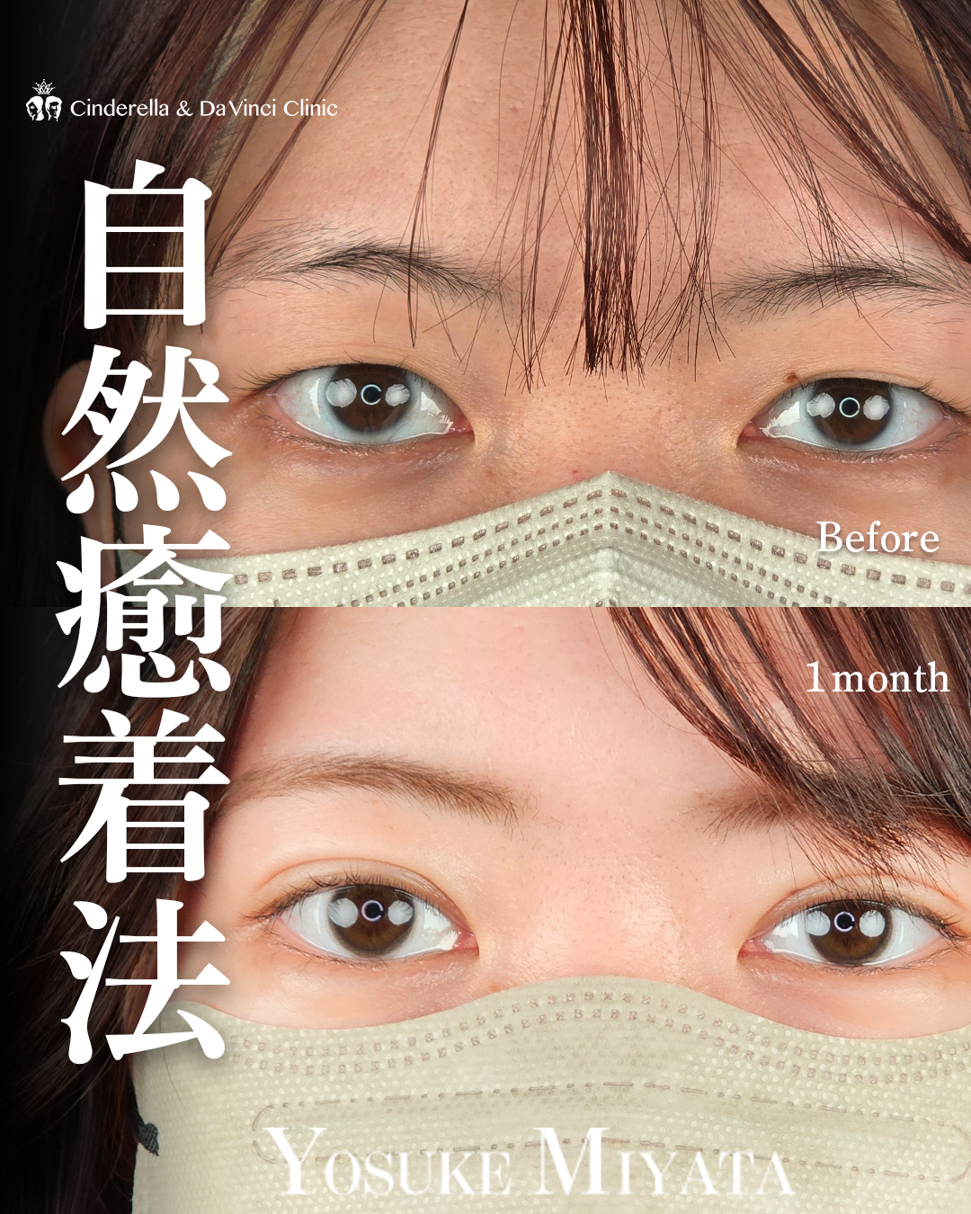 埋没で目の印象を変える