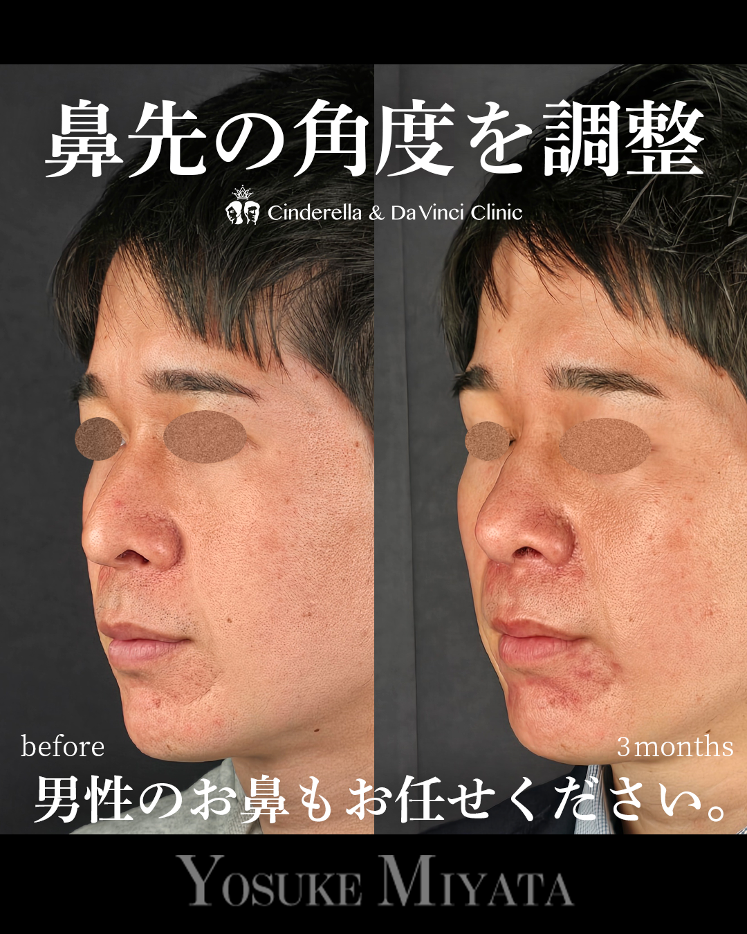 鼻先をツンとさせるの画像