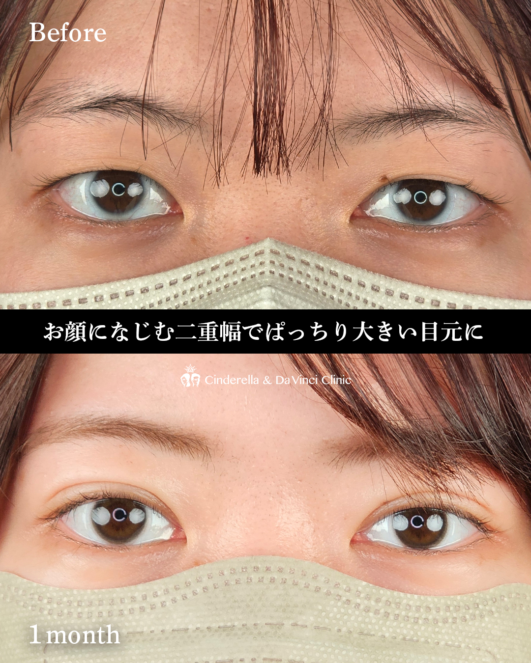 埋没で目の印象を変えるの画像