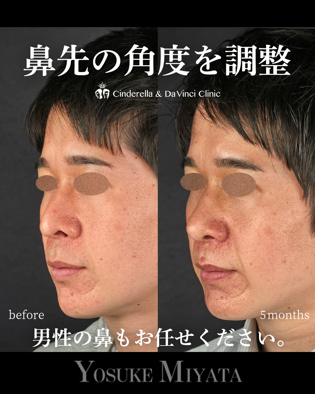 鼻先をツンとさせるの画像