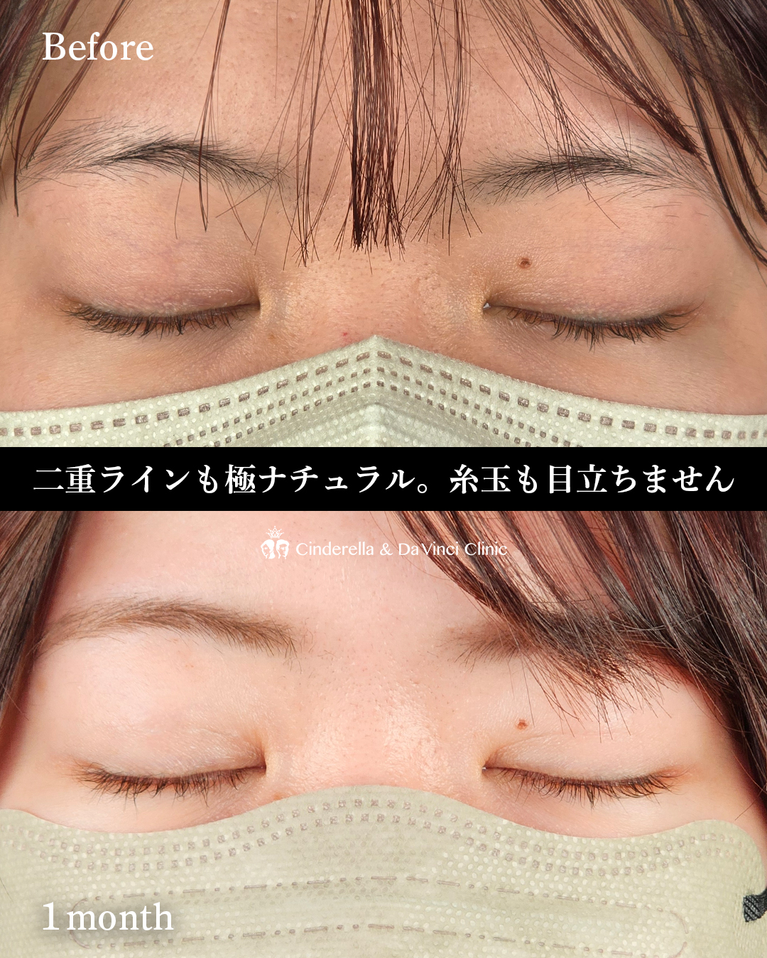 埋没で目の印象を変えるの画像