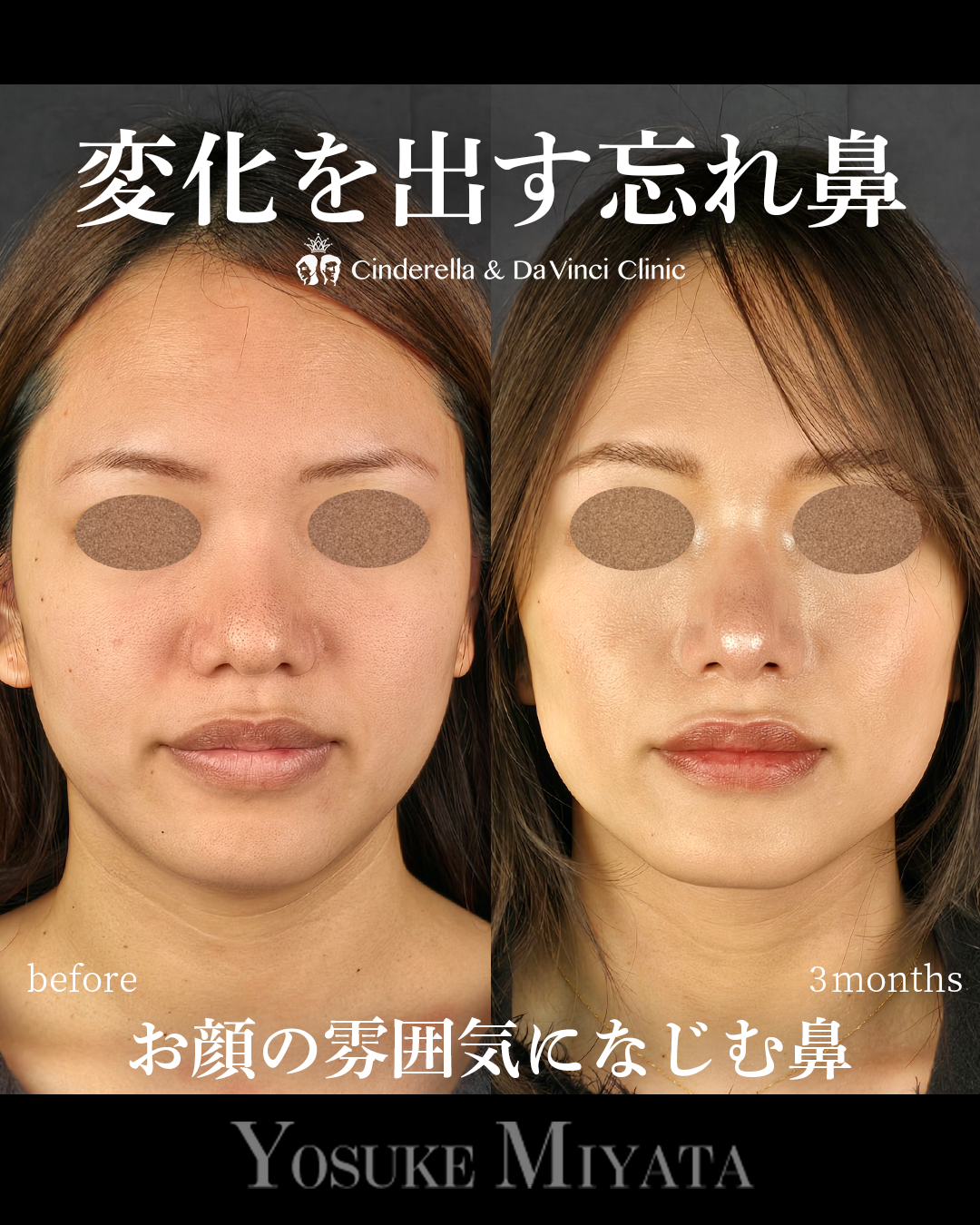 ナチュラルな忘れ鼻の画像